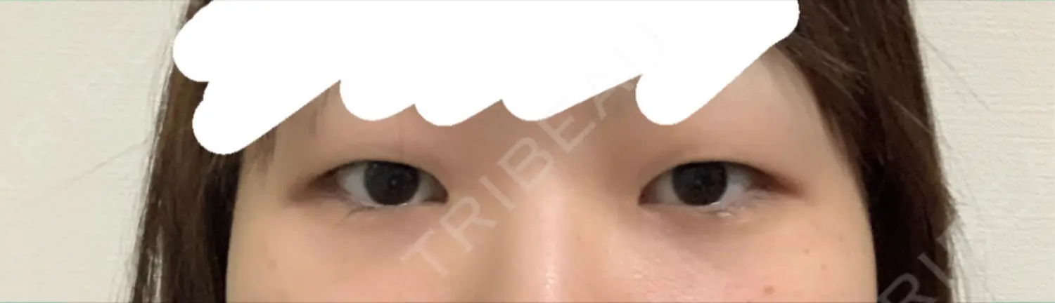 施術前の写真