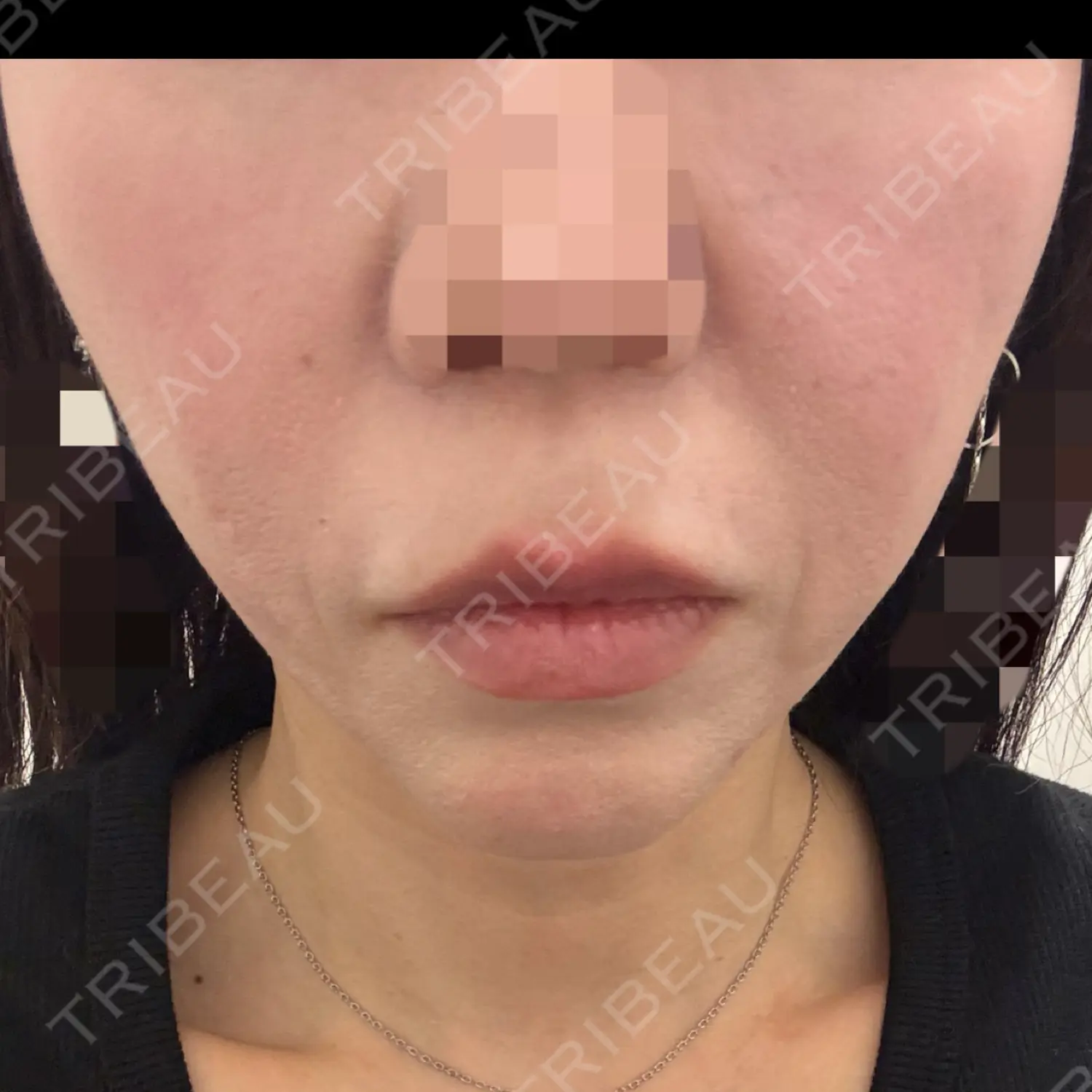 施術前の写真