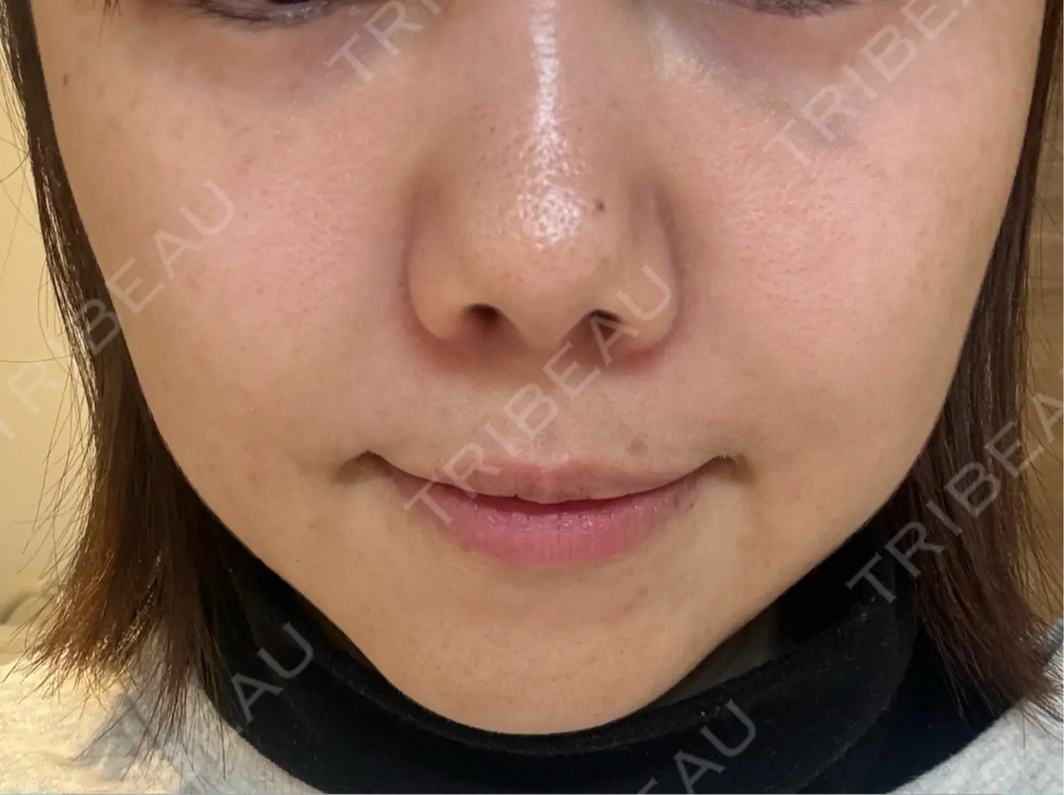 施術前の写真