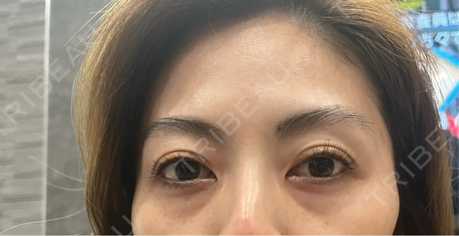 施術前の写真