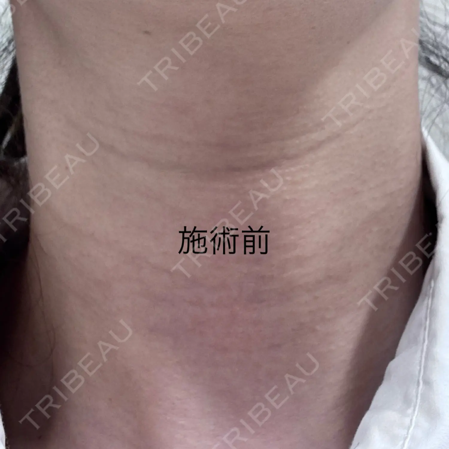 施術前の写真