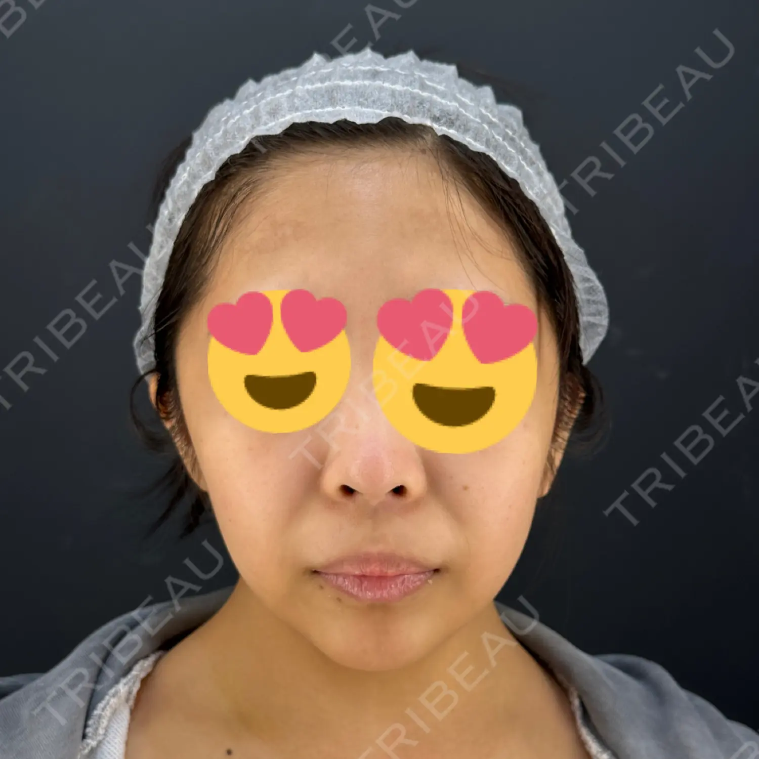施術前の写真