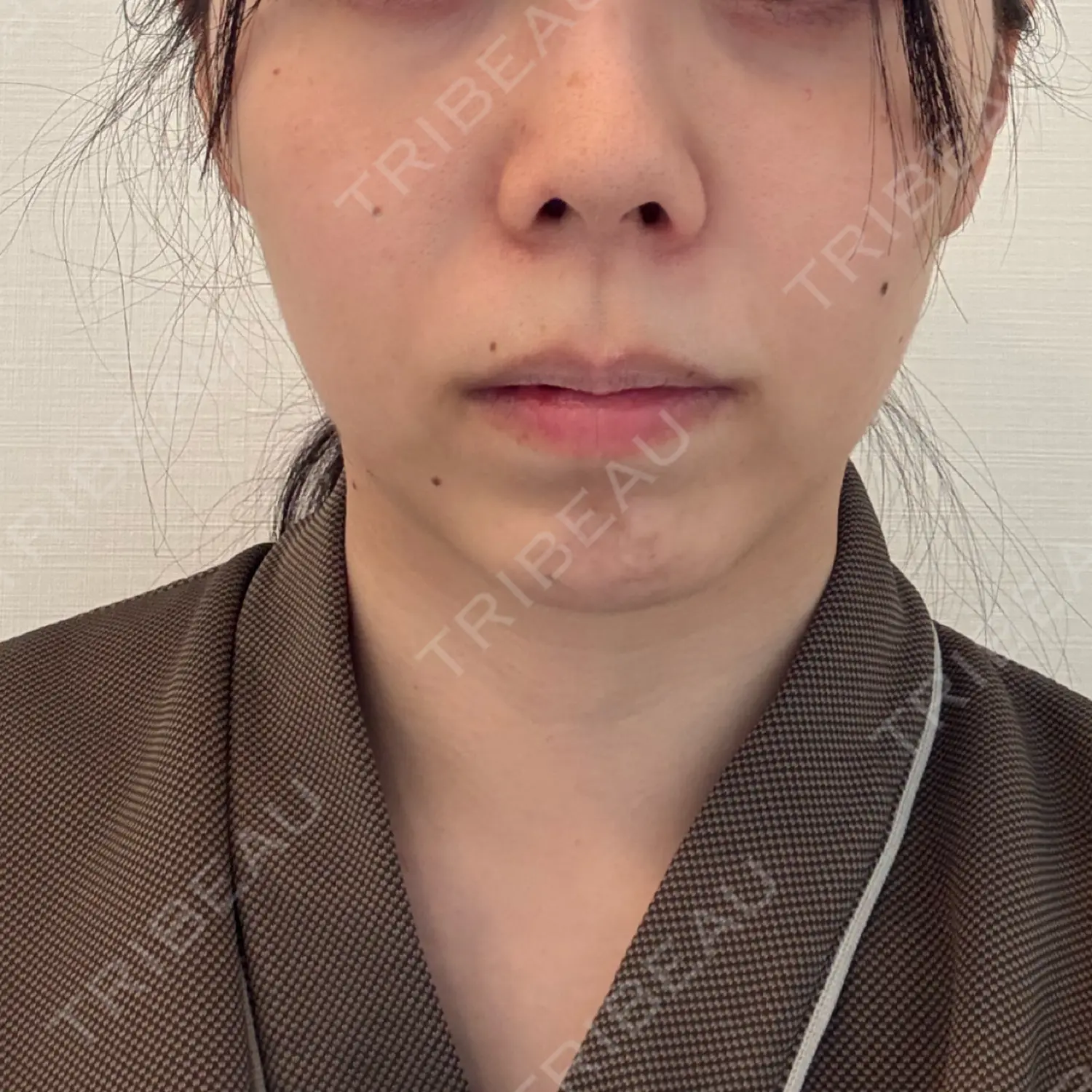 施術前の写真