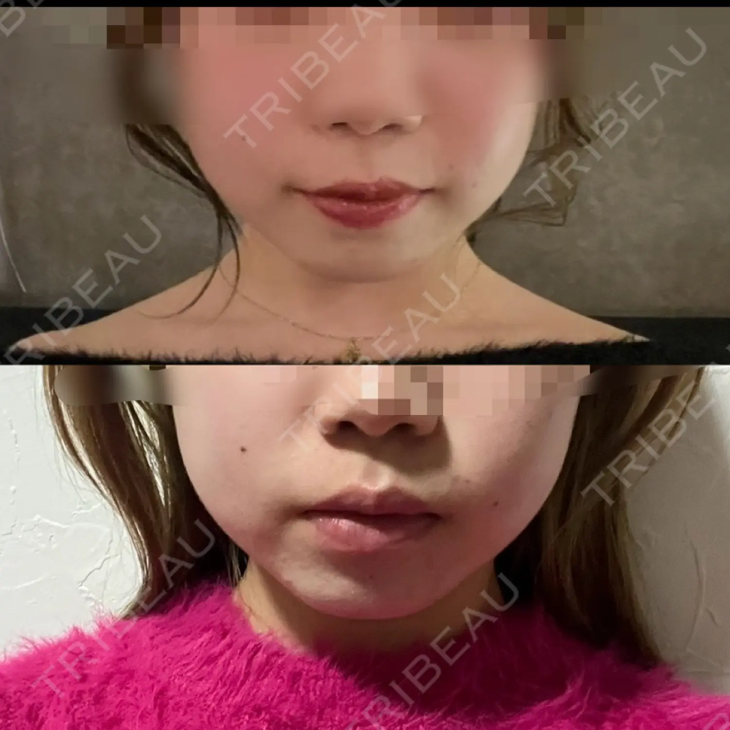 施術前の写真