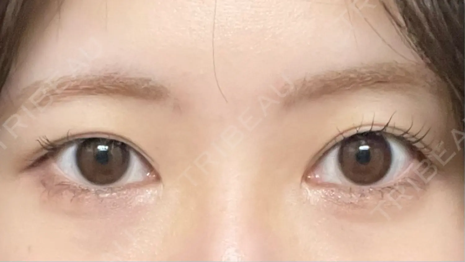 施術前の写真