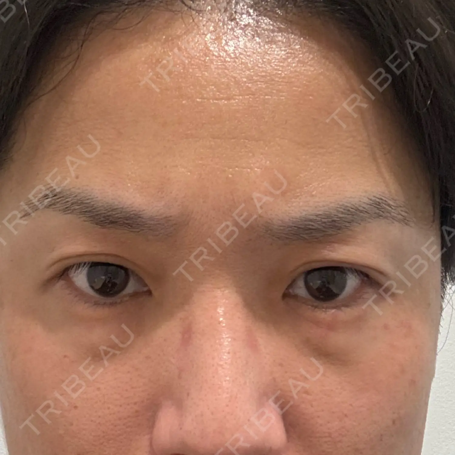 施術前の写真