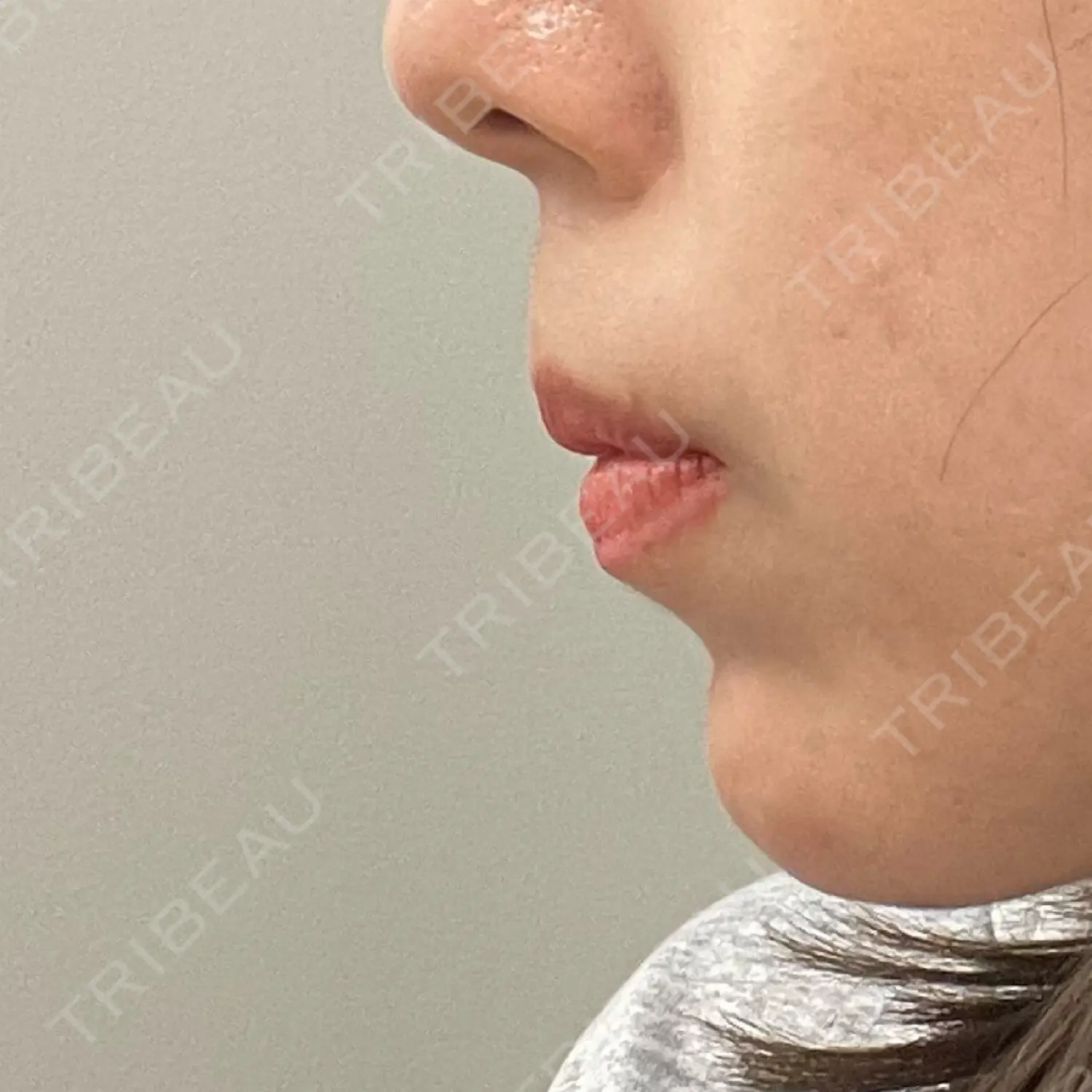 施術前の写真