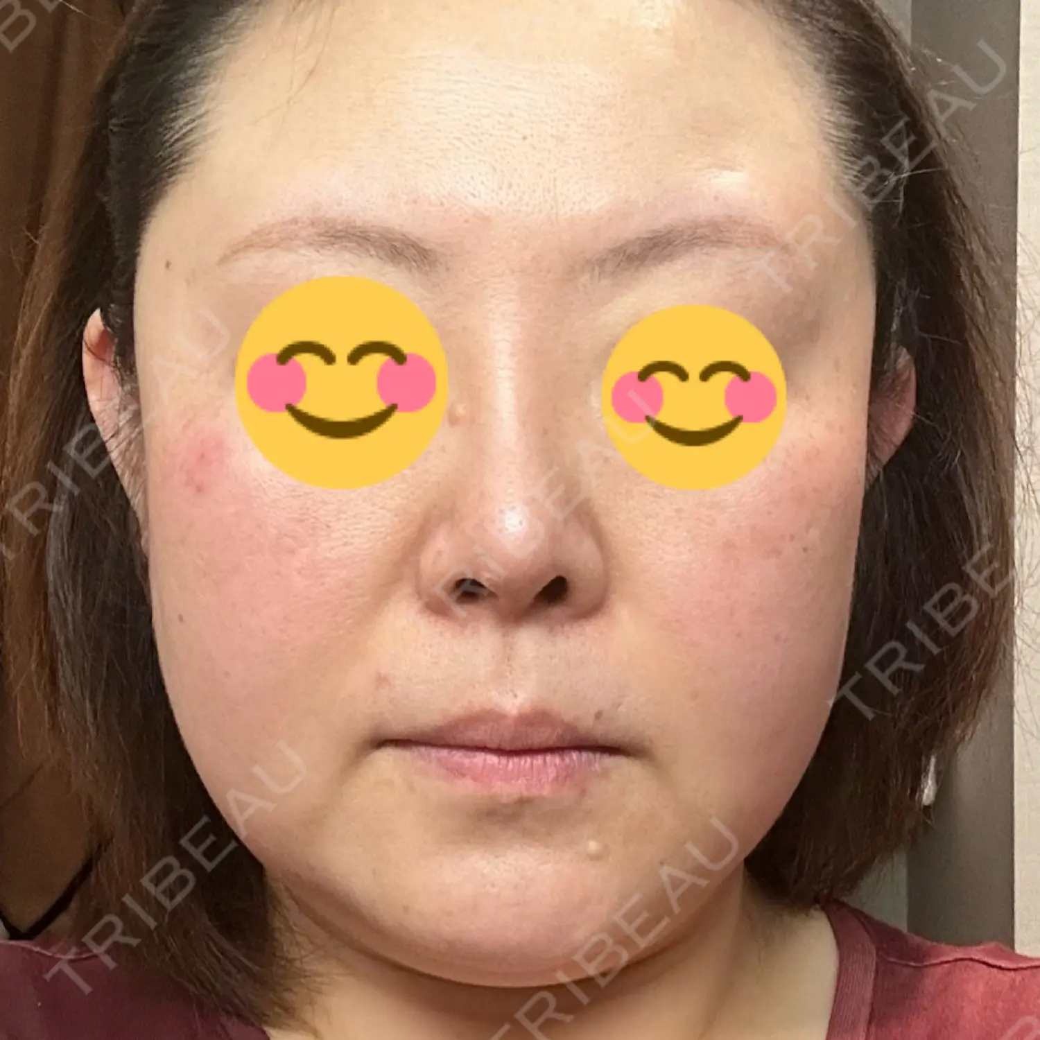 施術前の写真