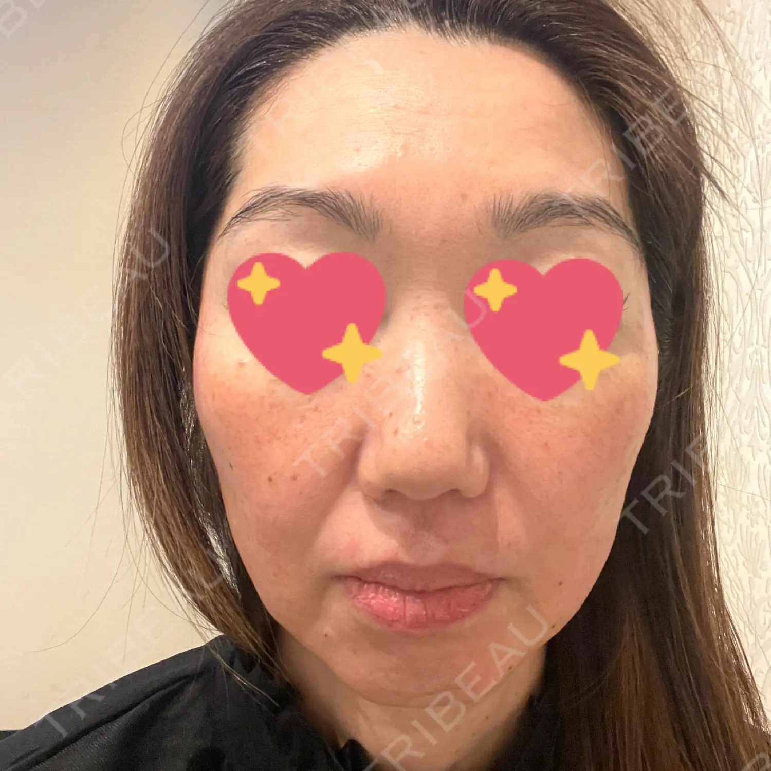 施術前の写真