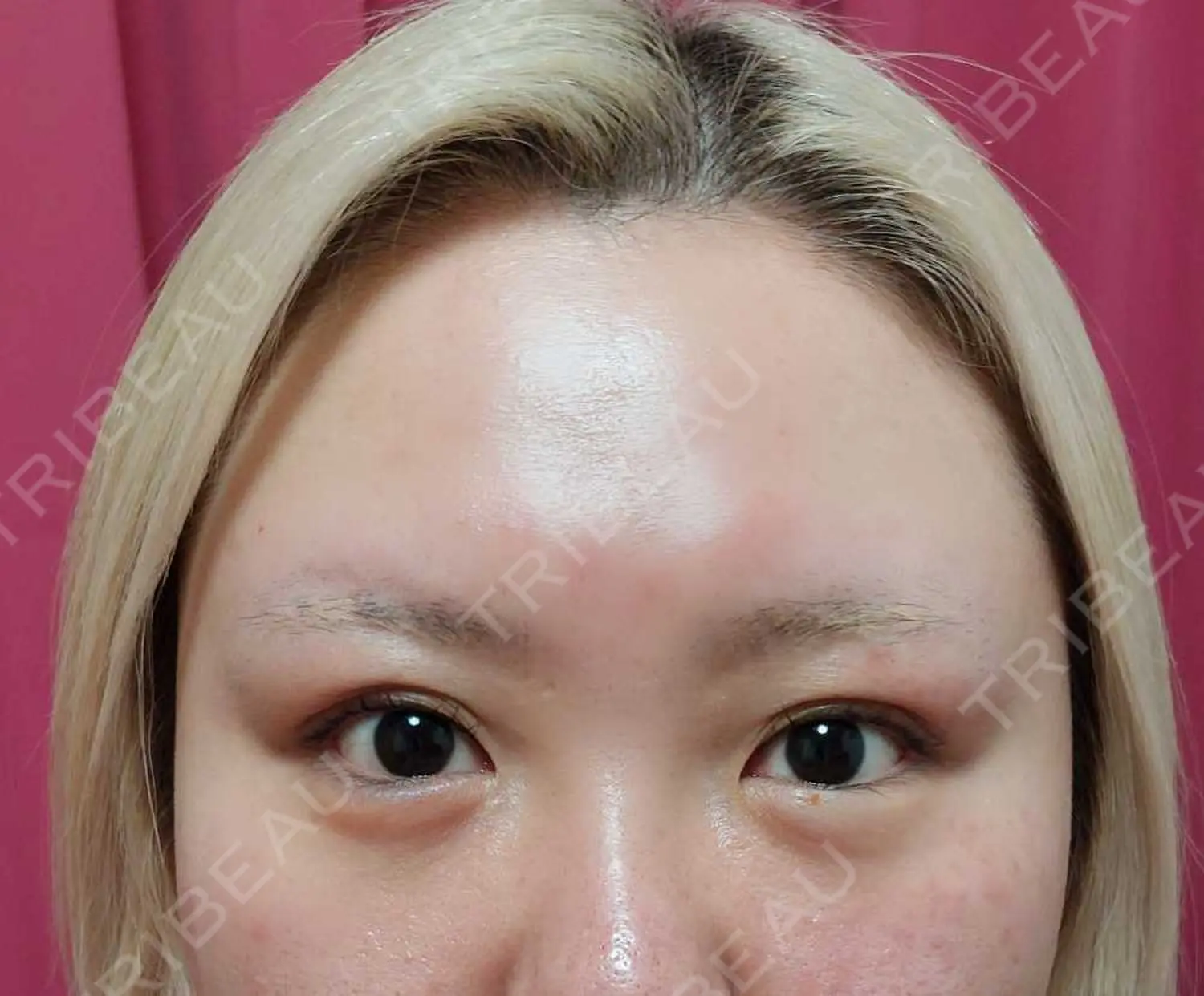 施術前の写真