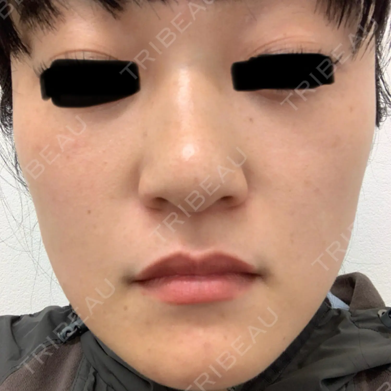 施術前の写真