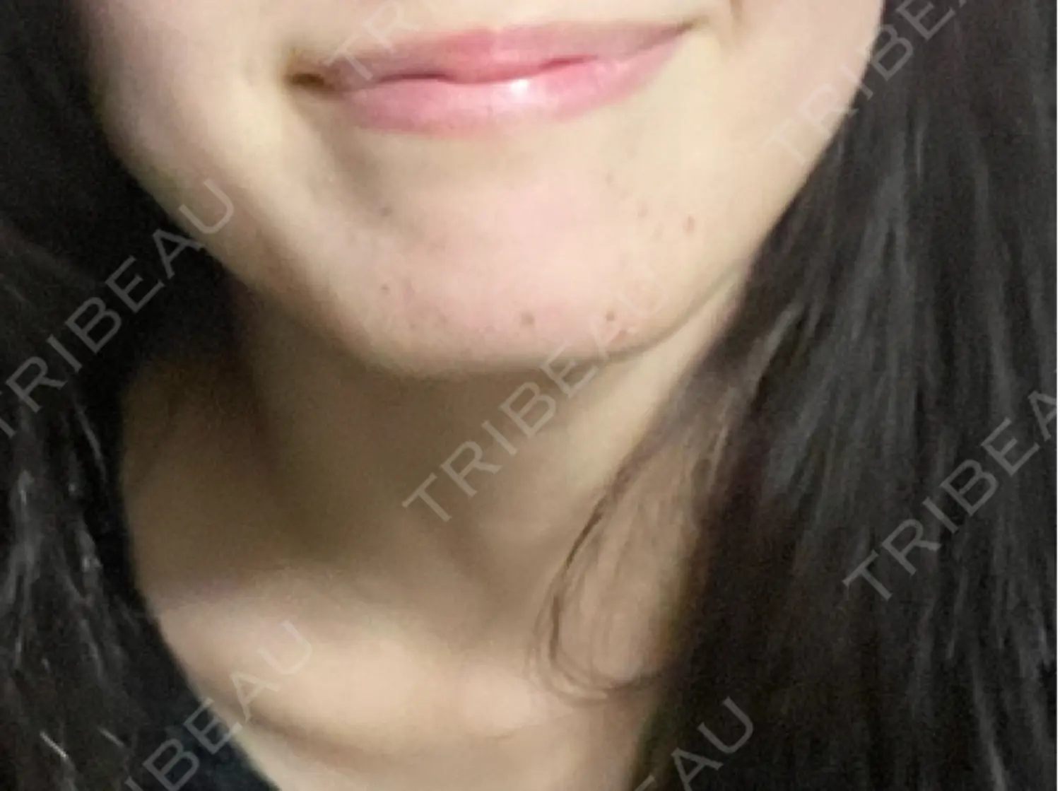 施術前の写真