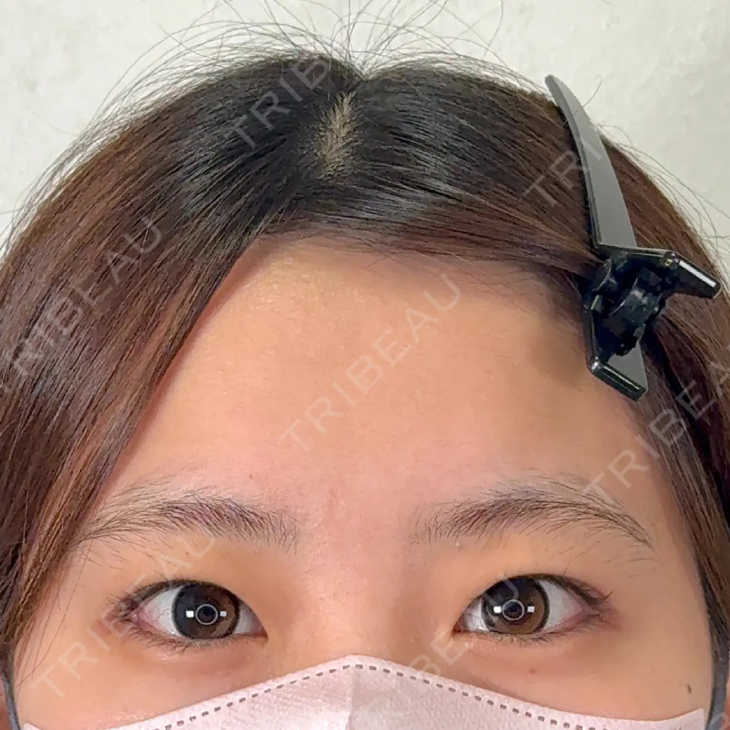 施術前の写真