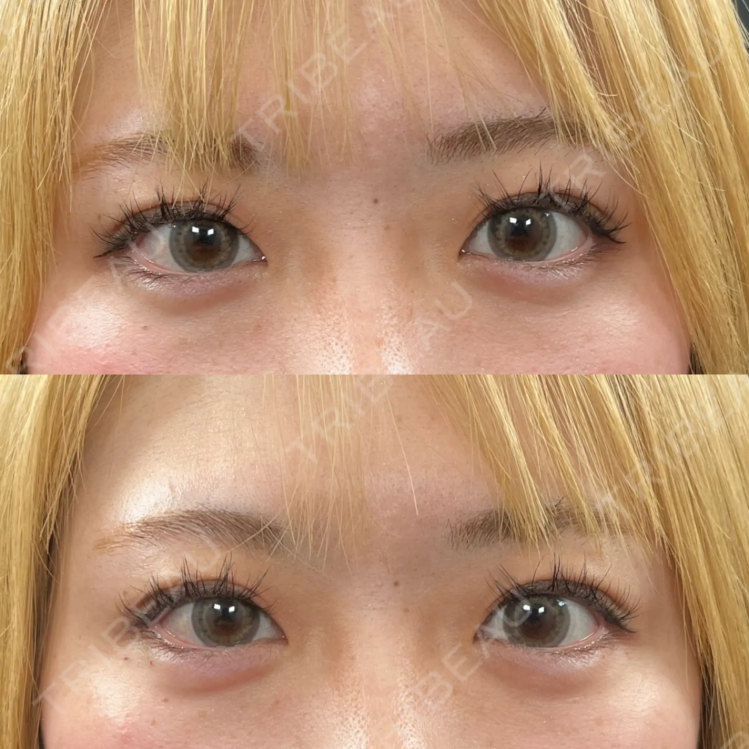 施術前の写真