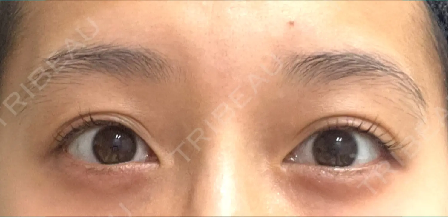 施術前の写真