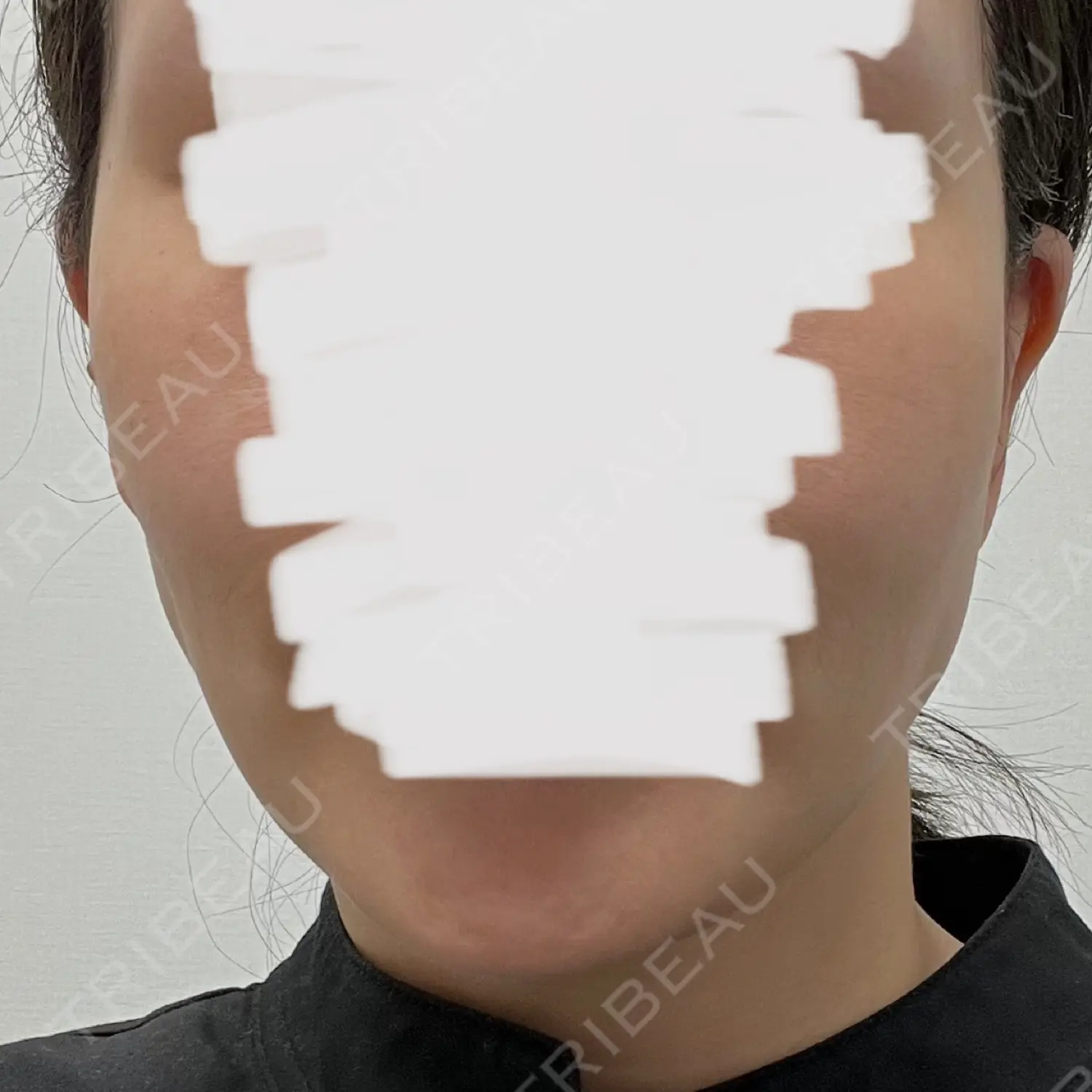 施術前の写真
