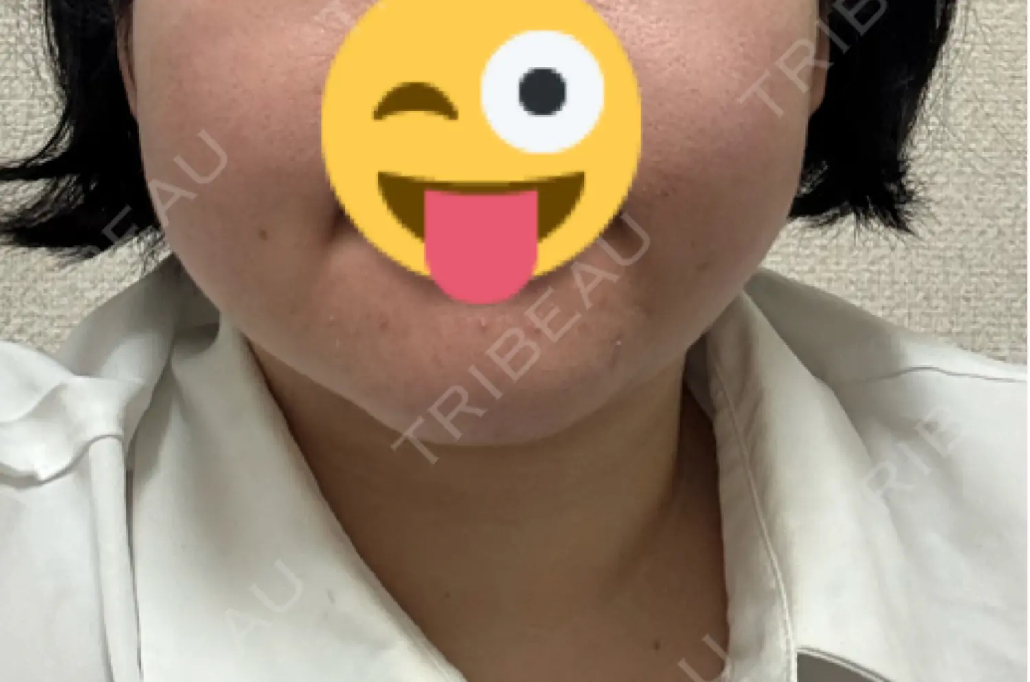 施術前の写真