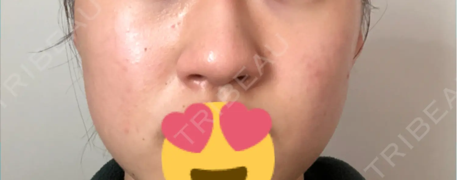 施術前の写真