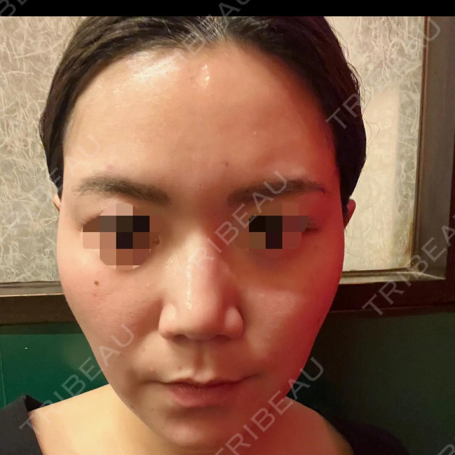 施術前の写真