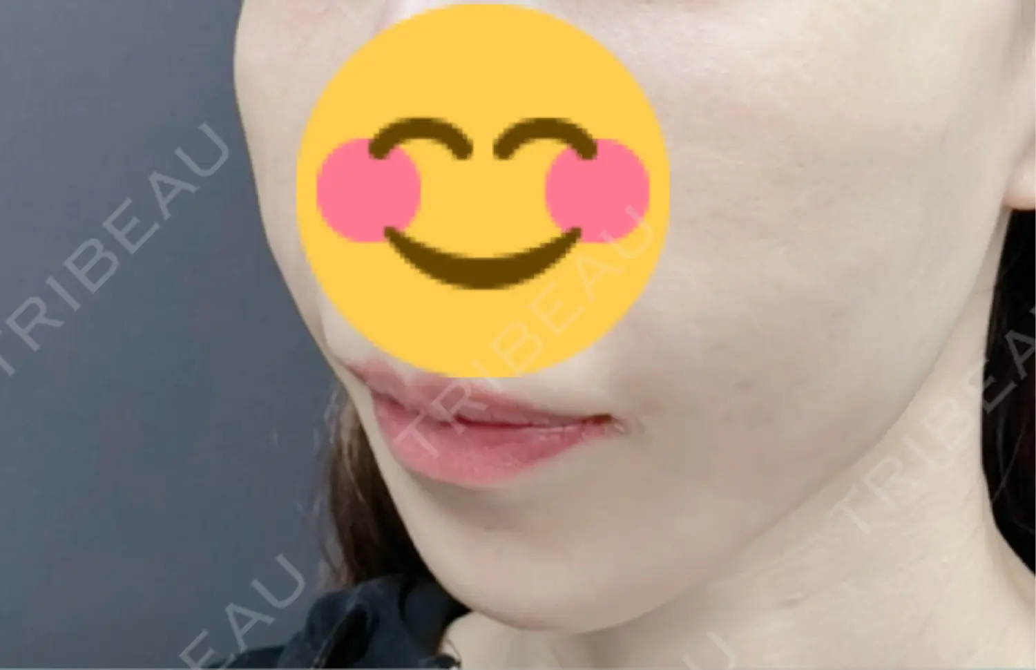 施術前の写真