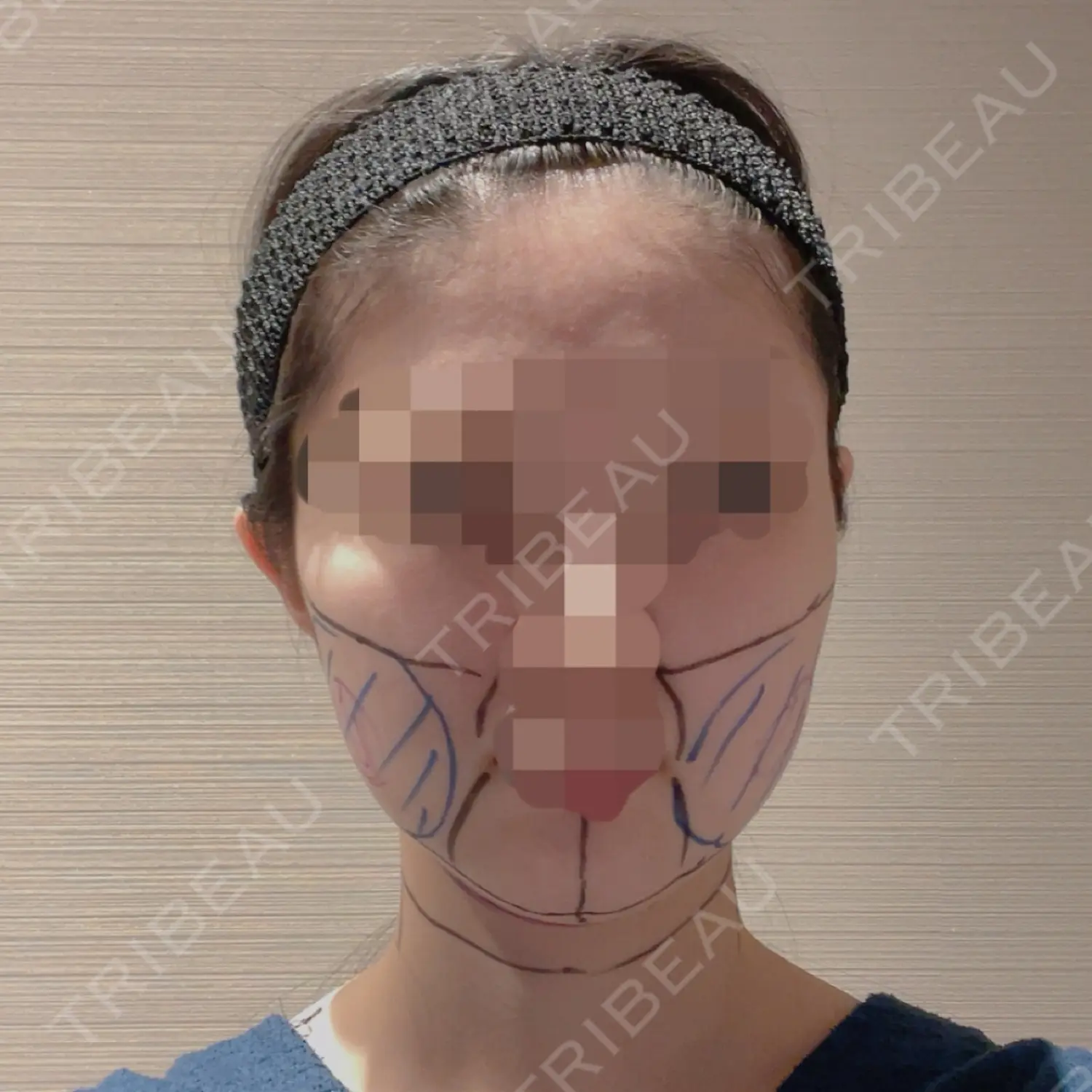 施術前の写真