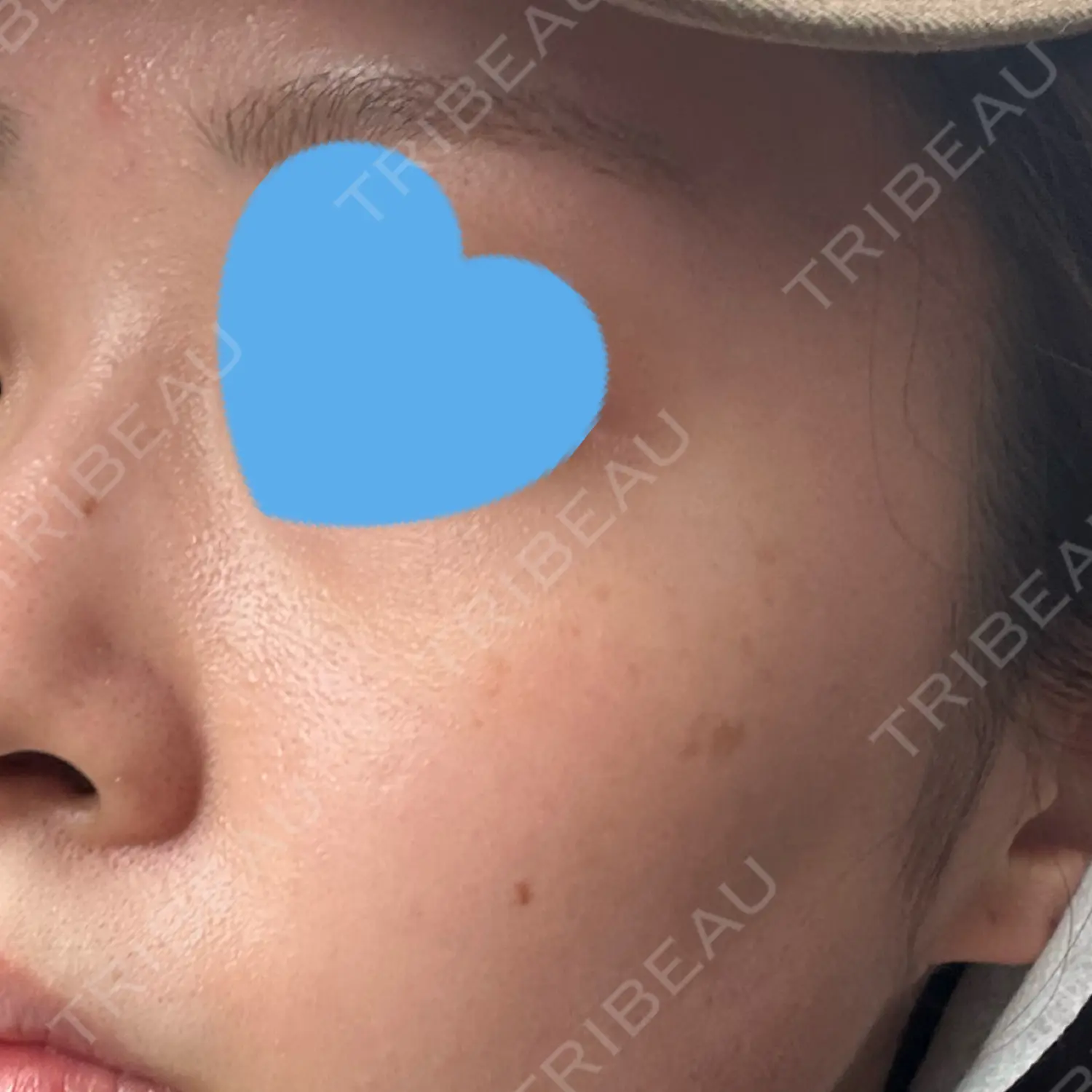 施術前の写真