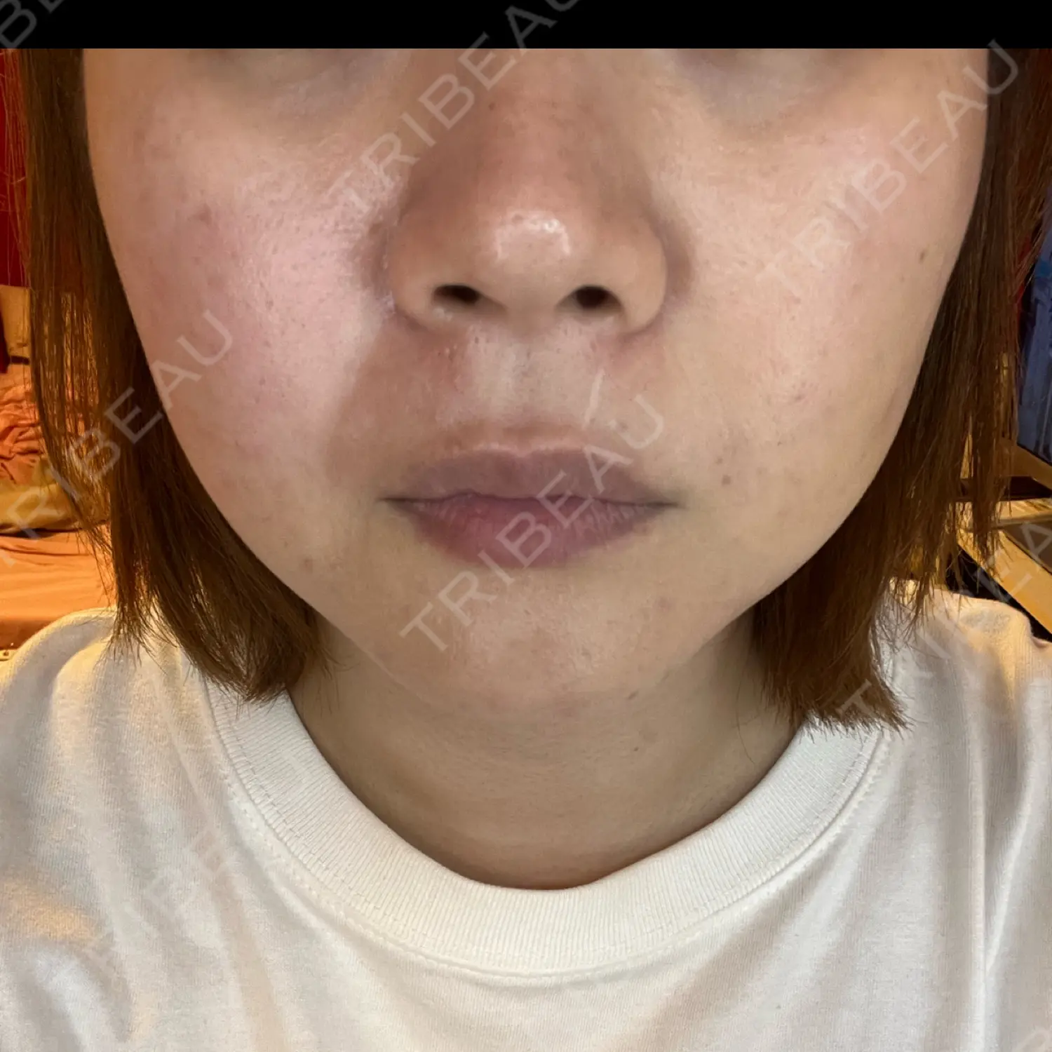 施術前の写真