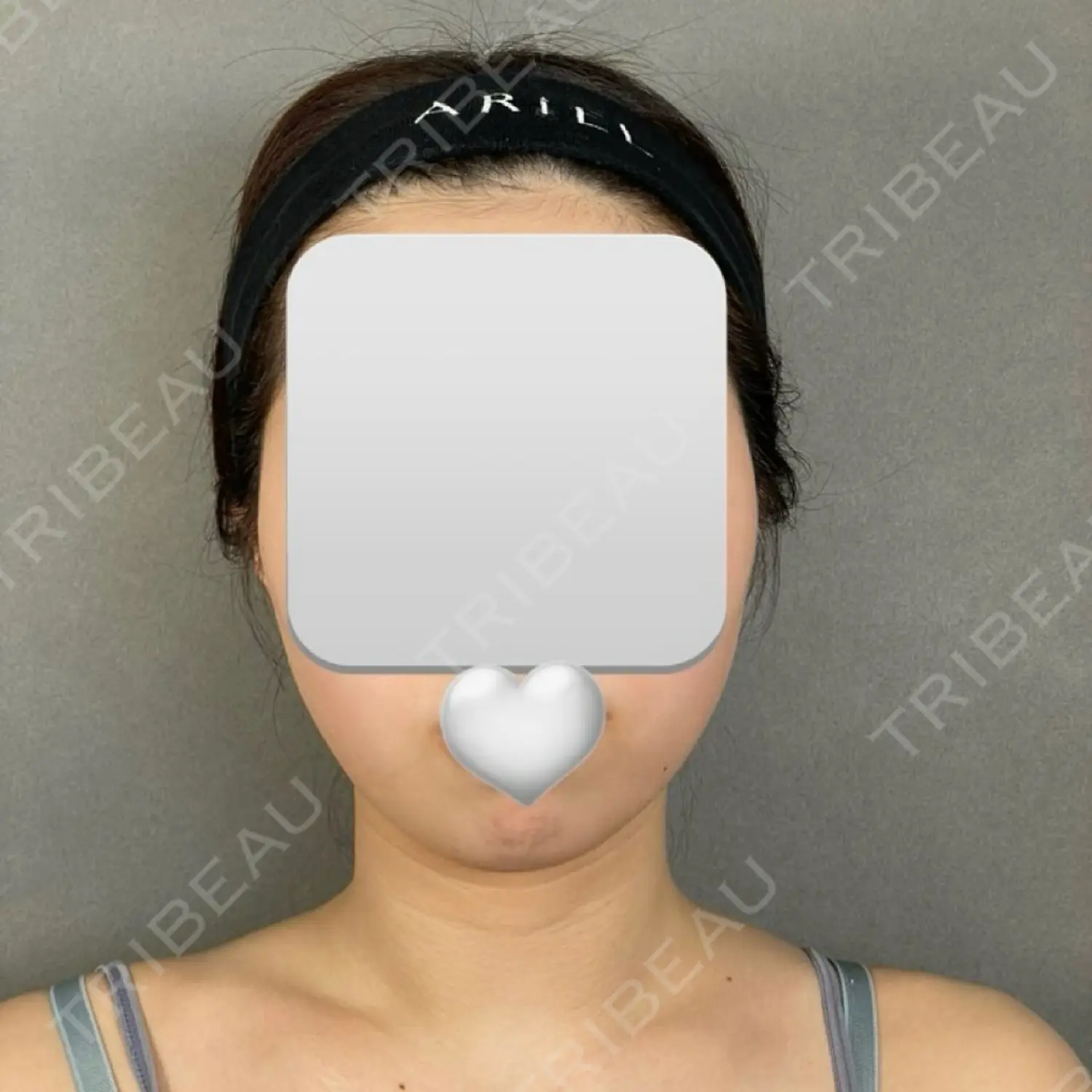 施術前の写真