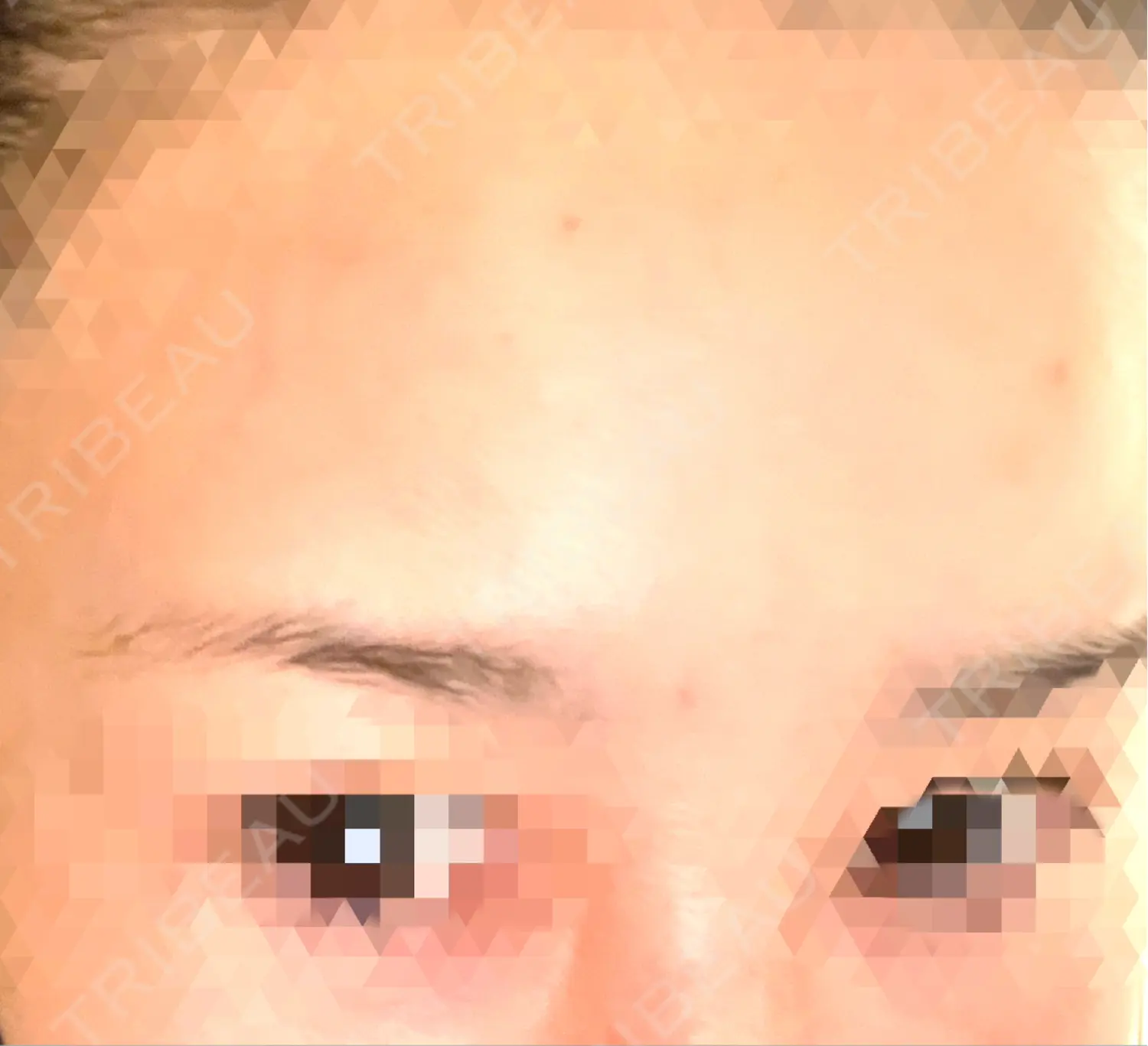 施術前の写真