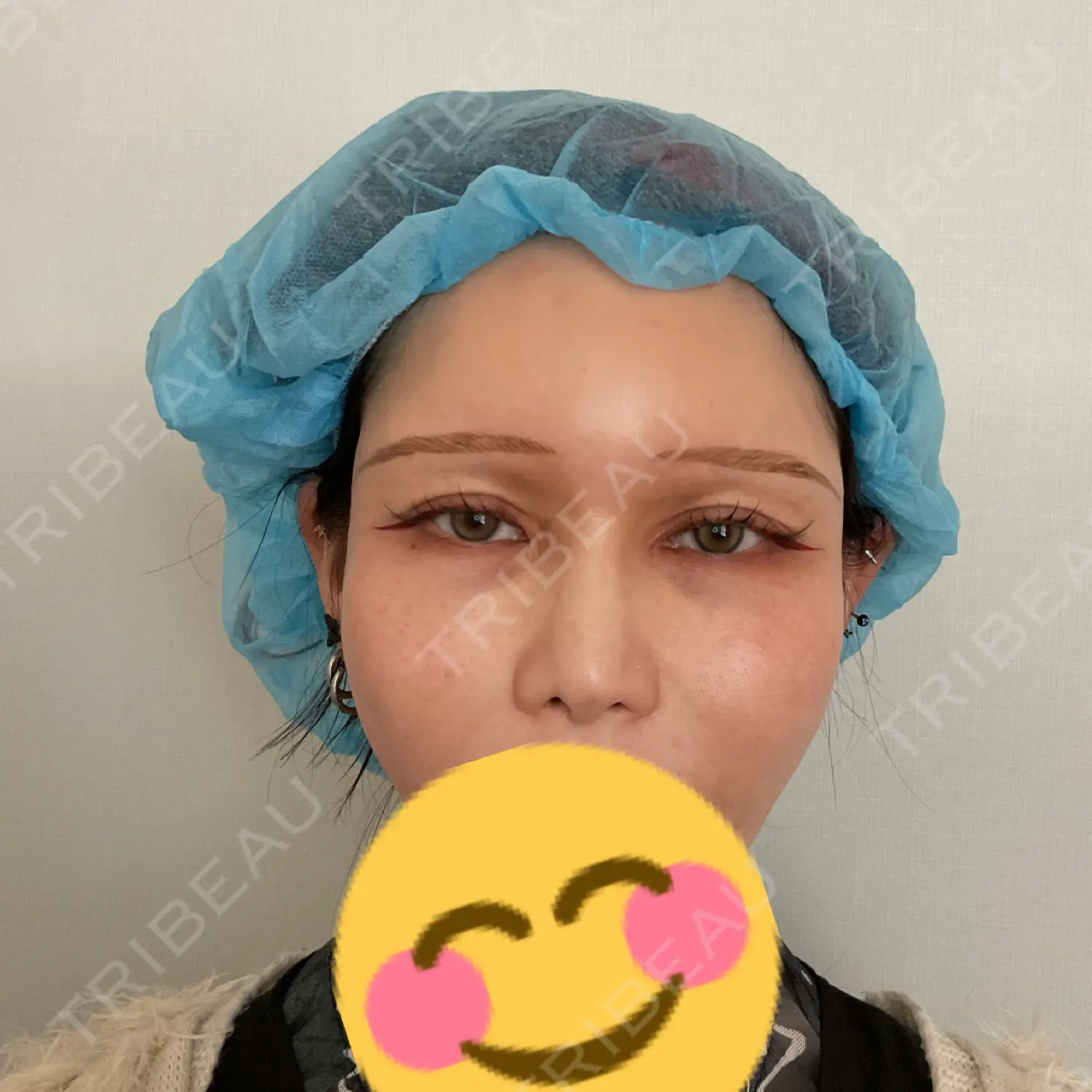 施術前の写真