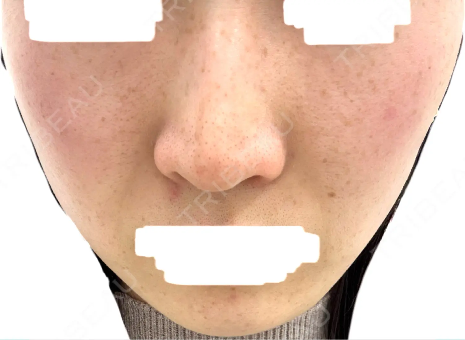 施術前の写真