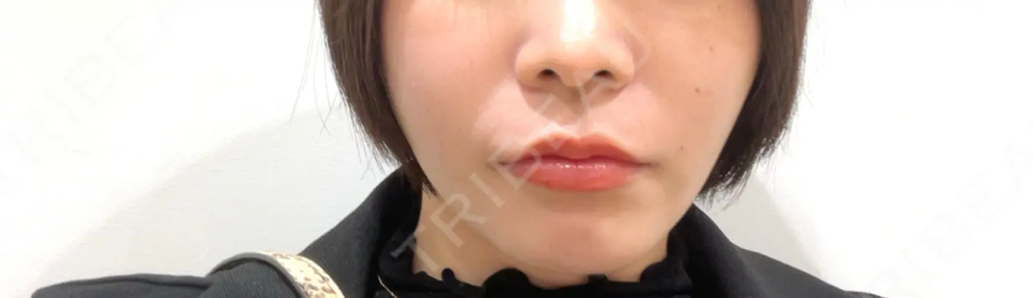 施術前の写真