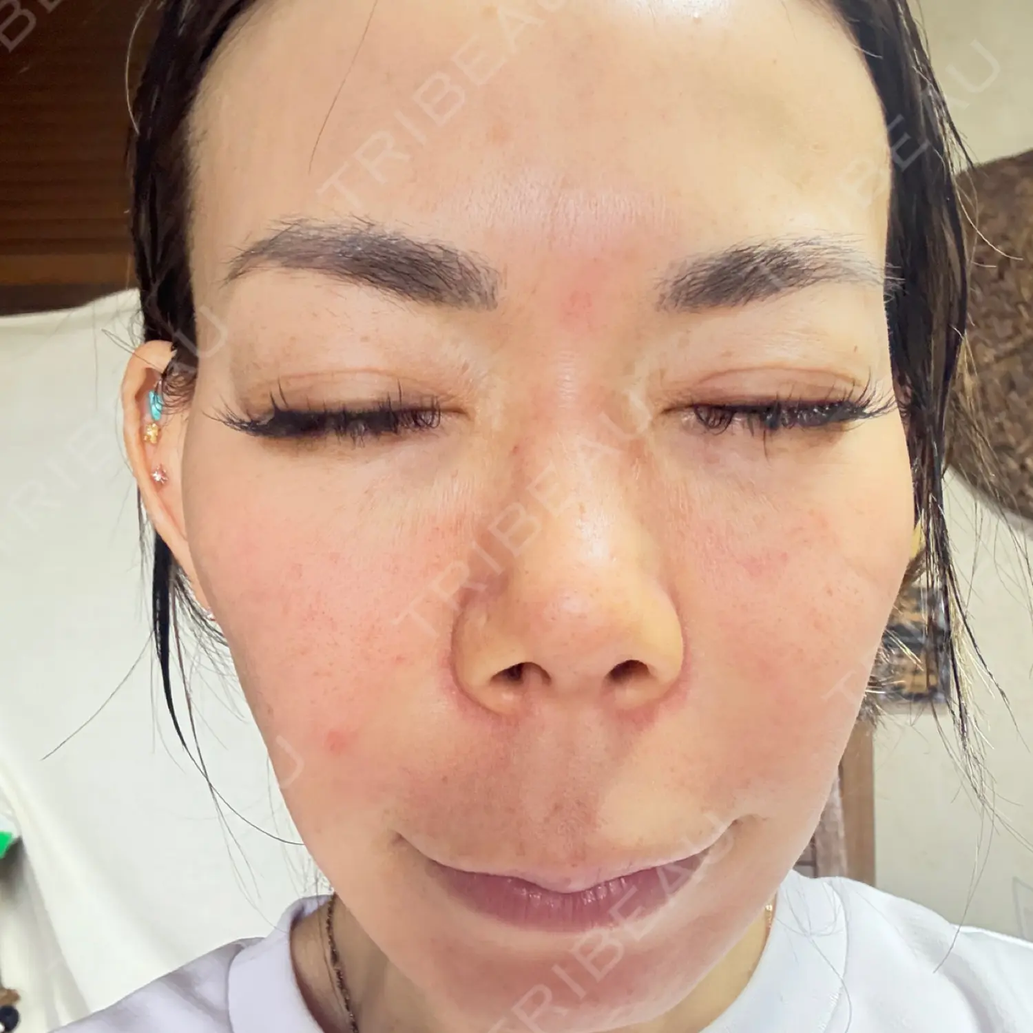 施術前の写真