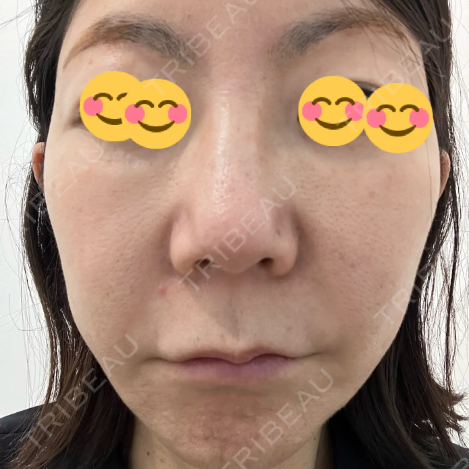 施術前の写真