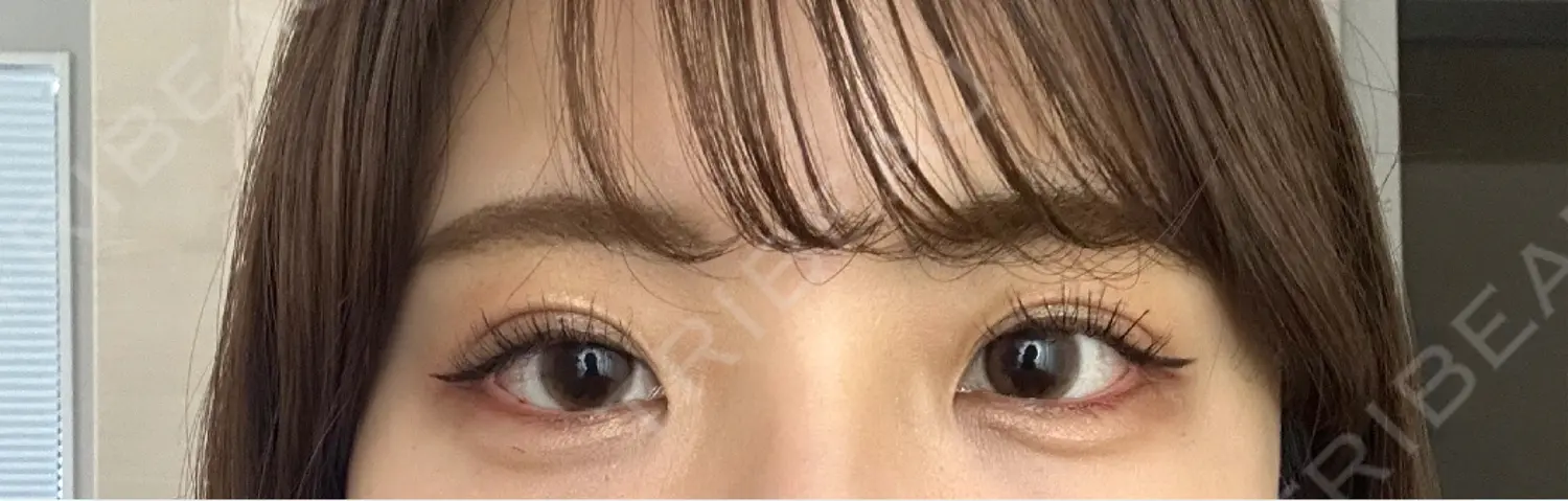 施術前の写真
