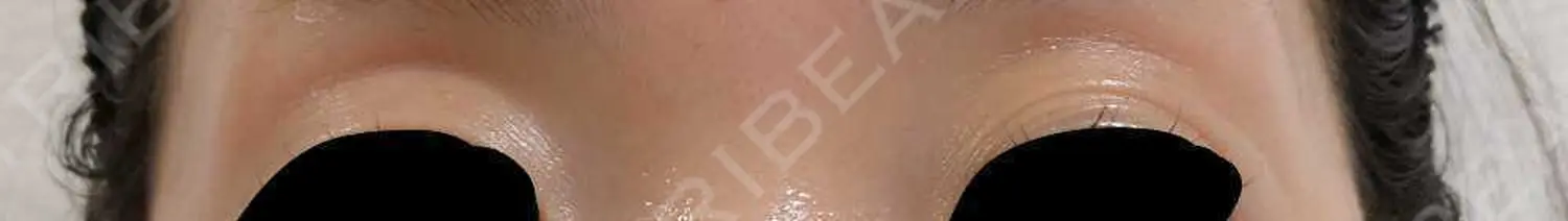 施術前の写真