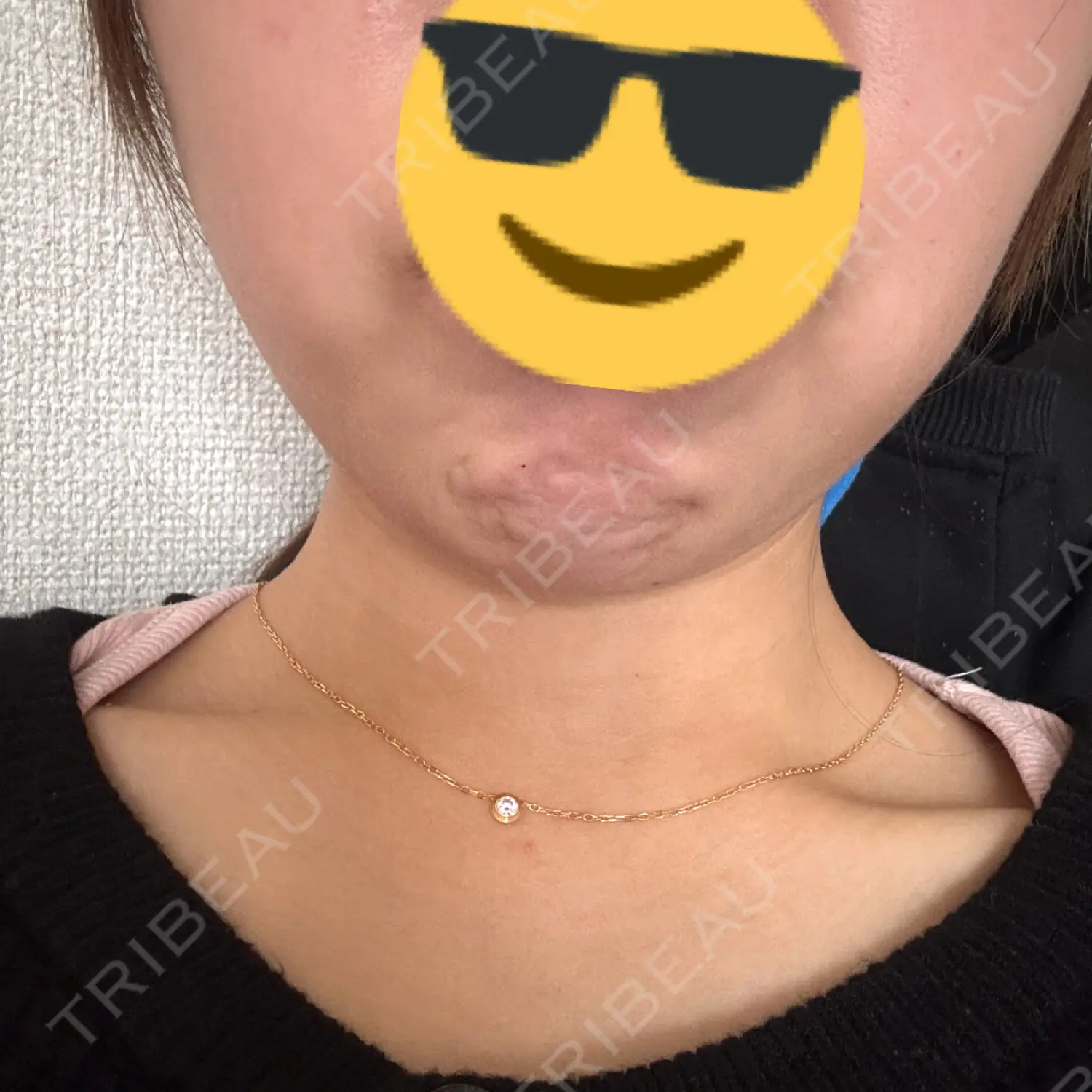 施術前の写真