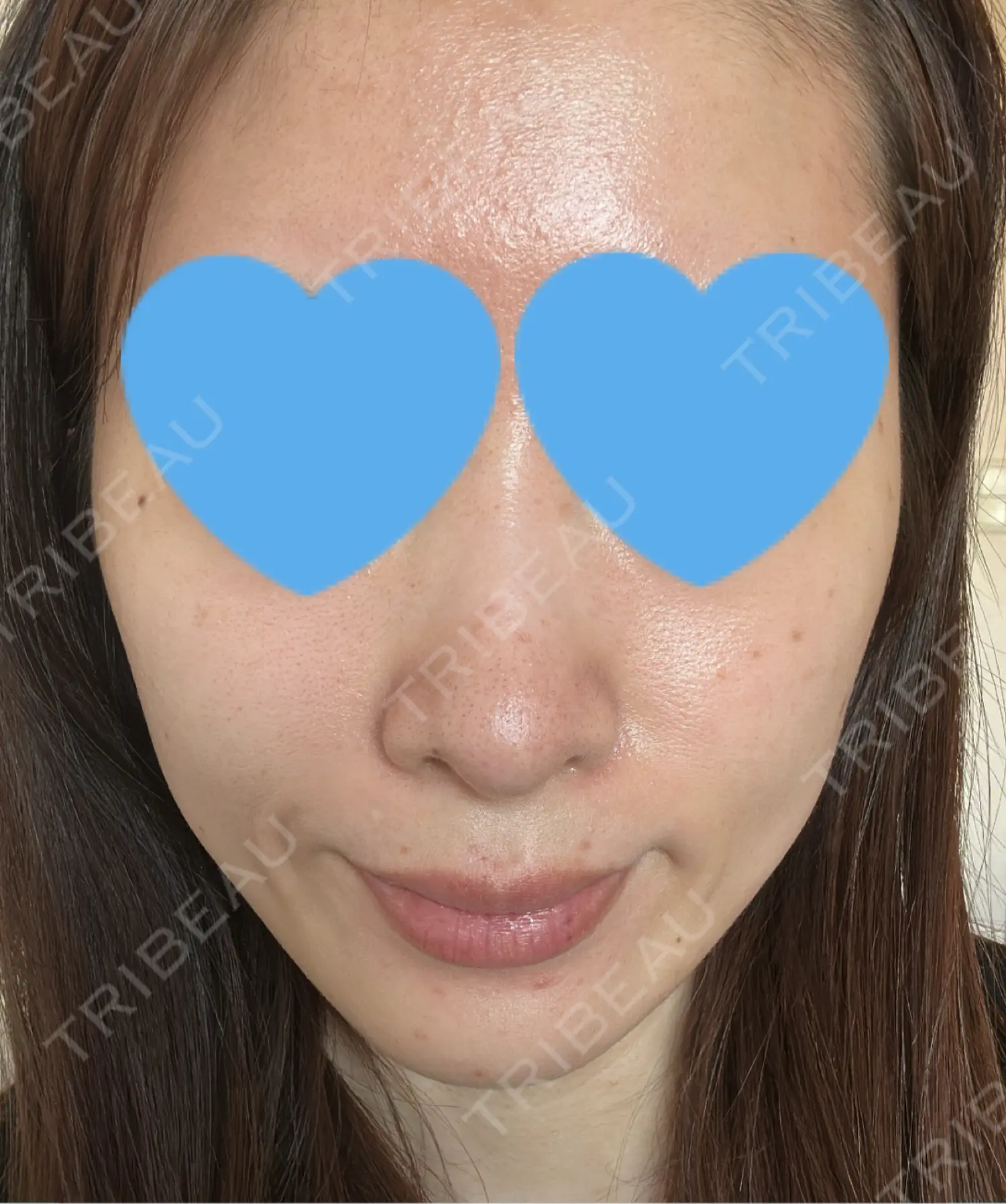 施術前の写真