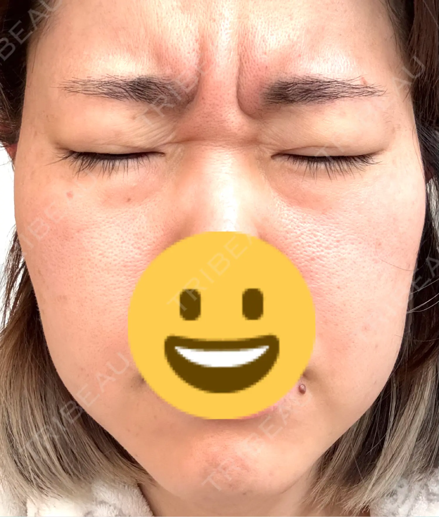 施術前の写真