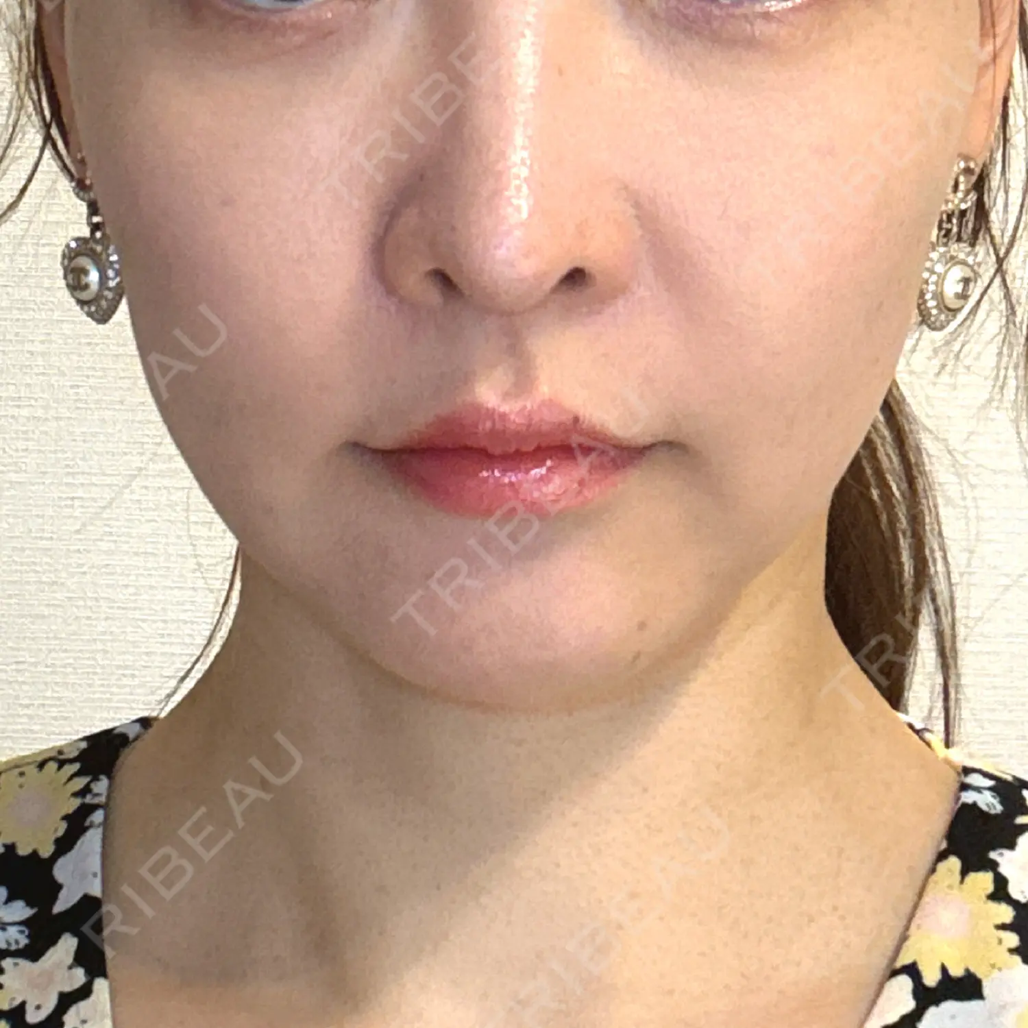 施術前の写真