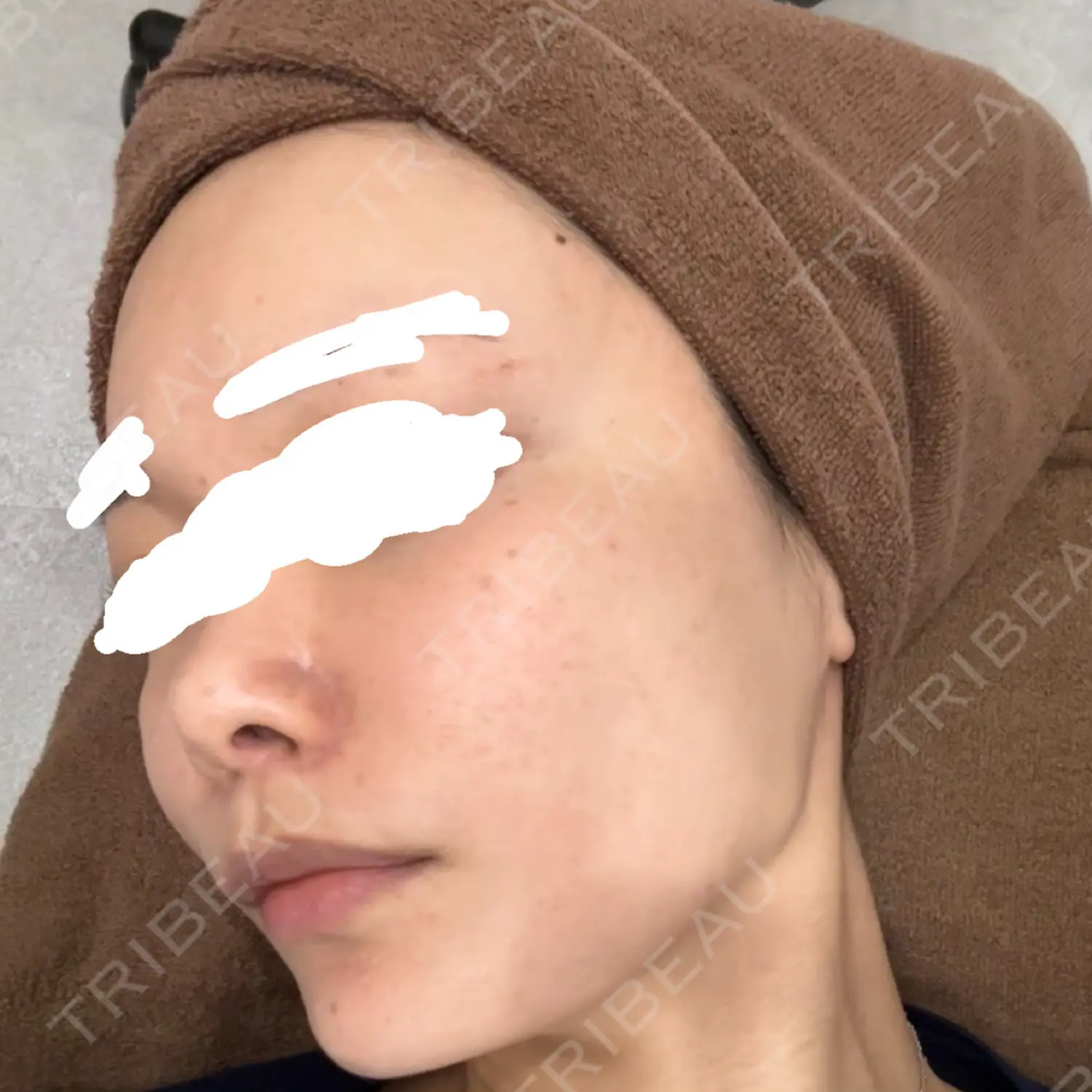 施術前の写真