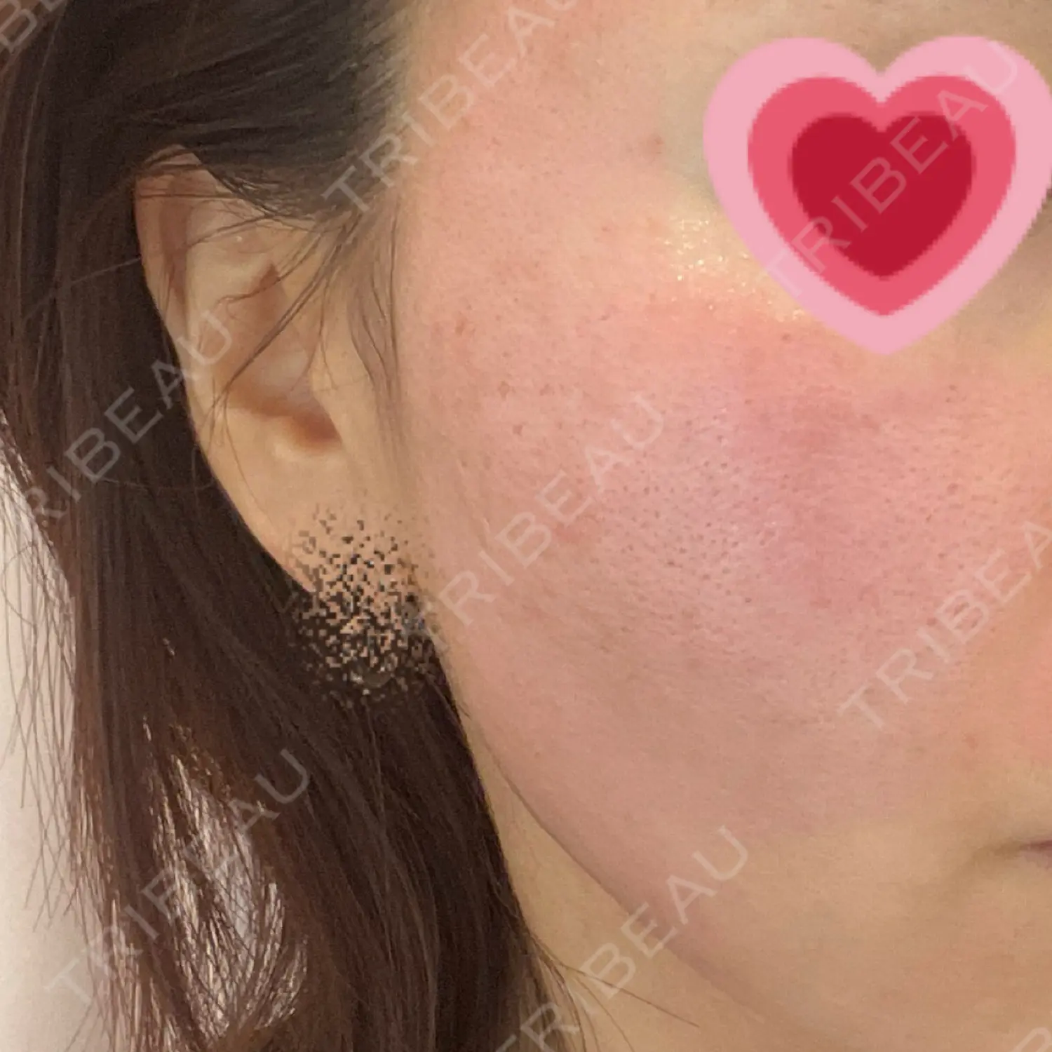 施術前の写真
