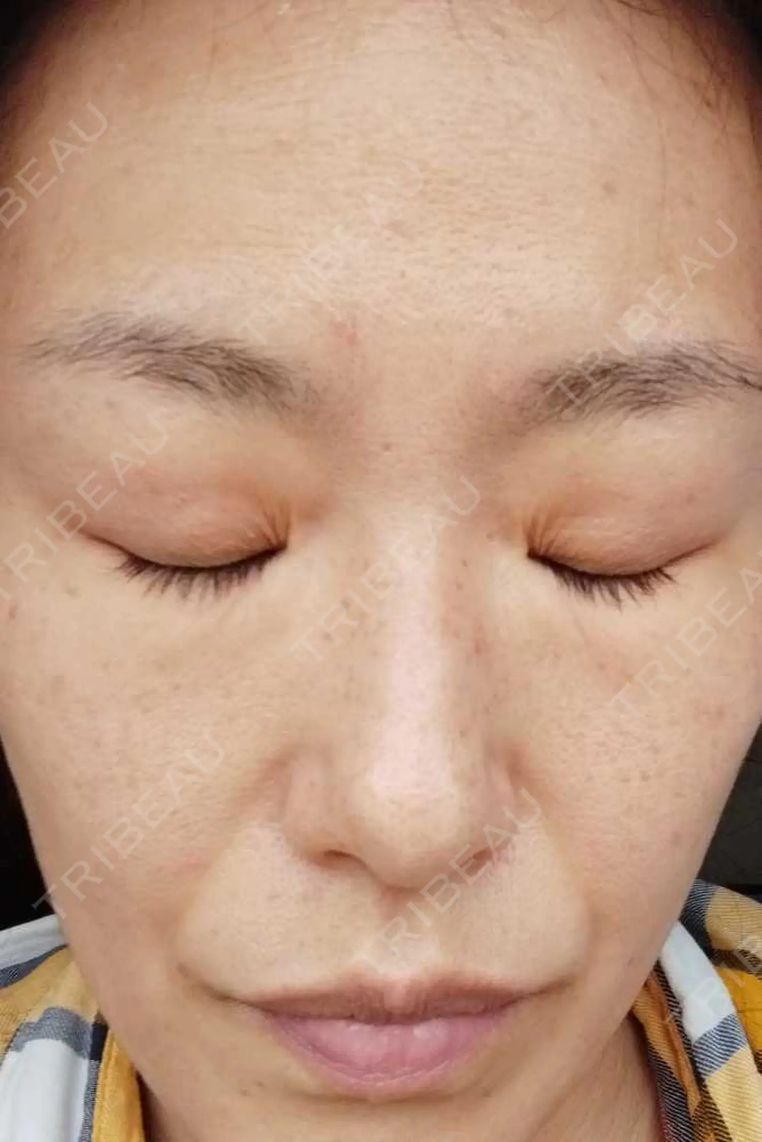 施術前の写真
