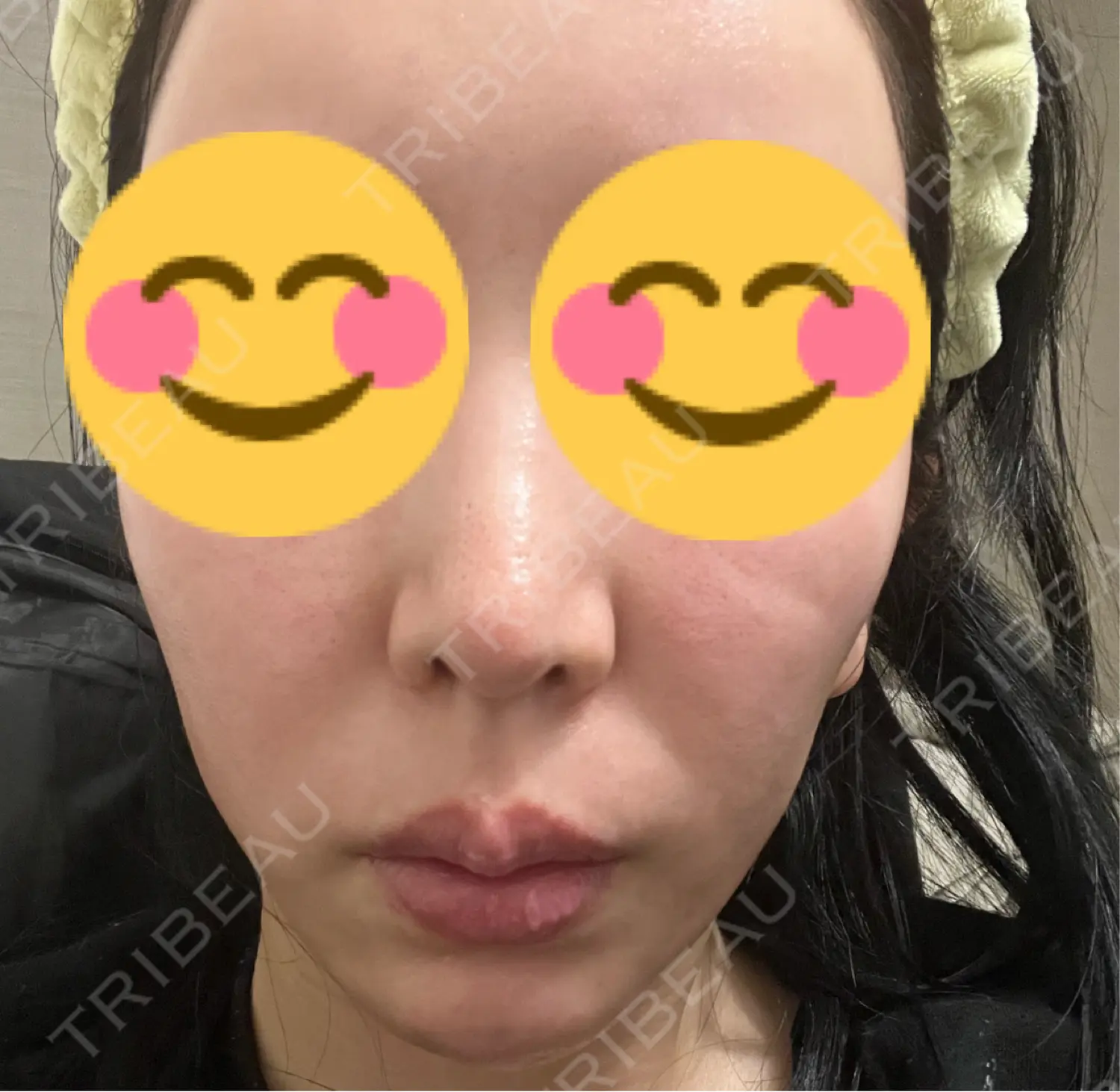 施術前の写真