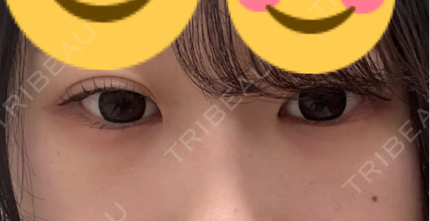 施術前の写真