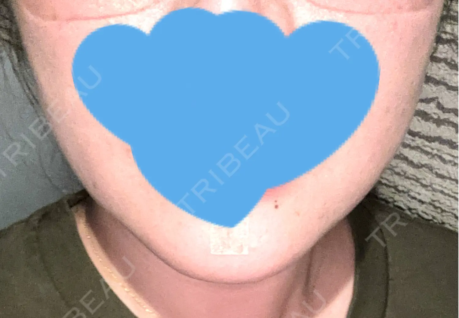 施術前の写真