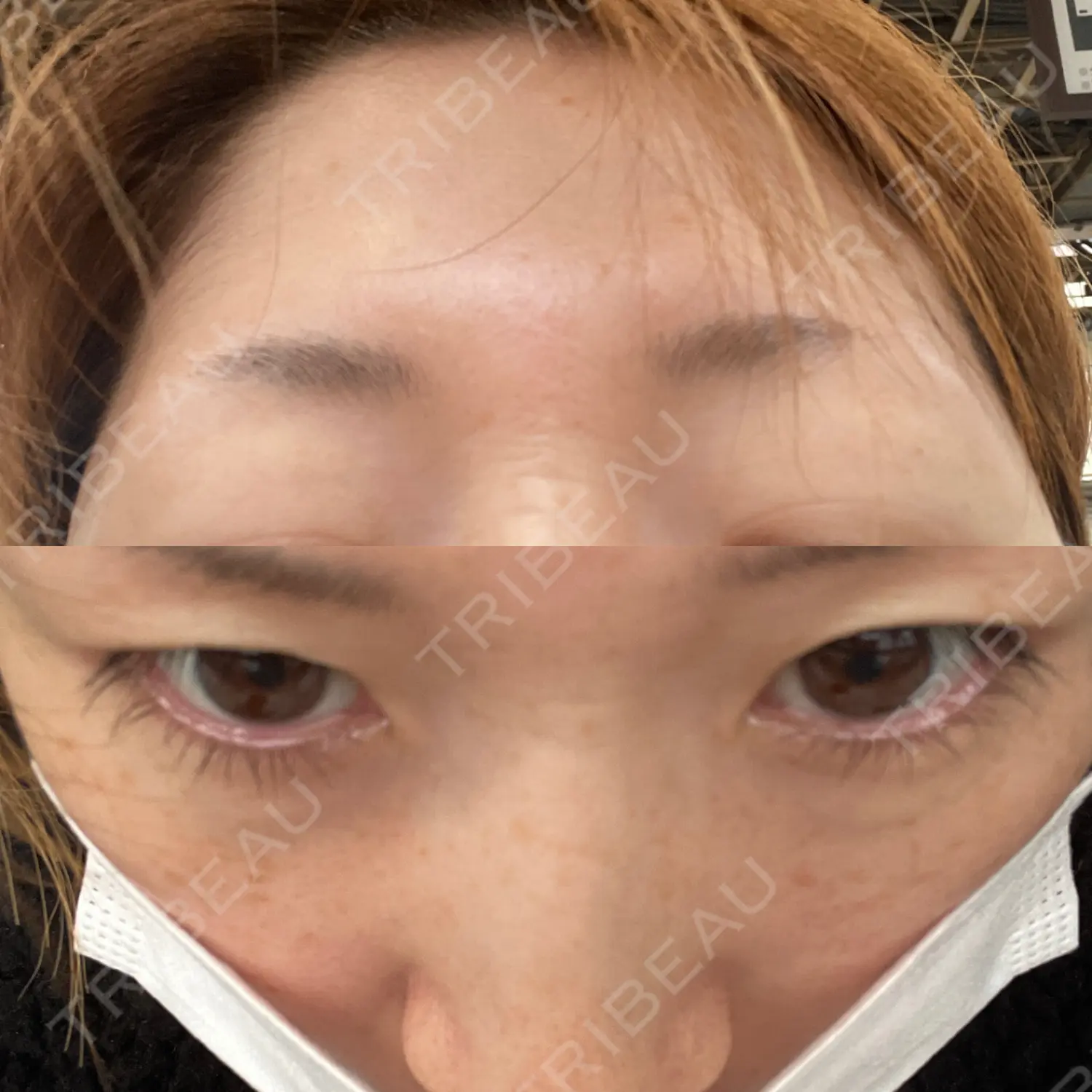施術前の写真