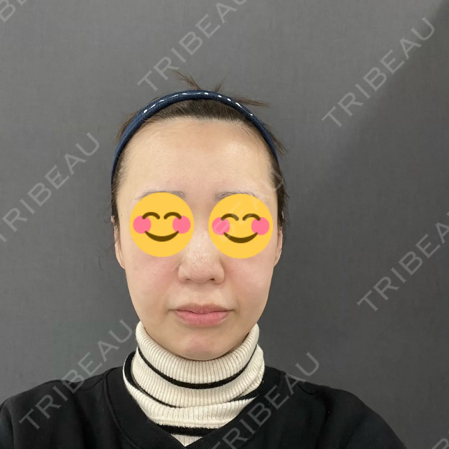 施術前の写真