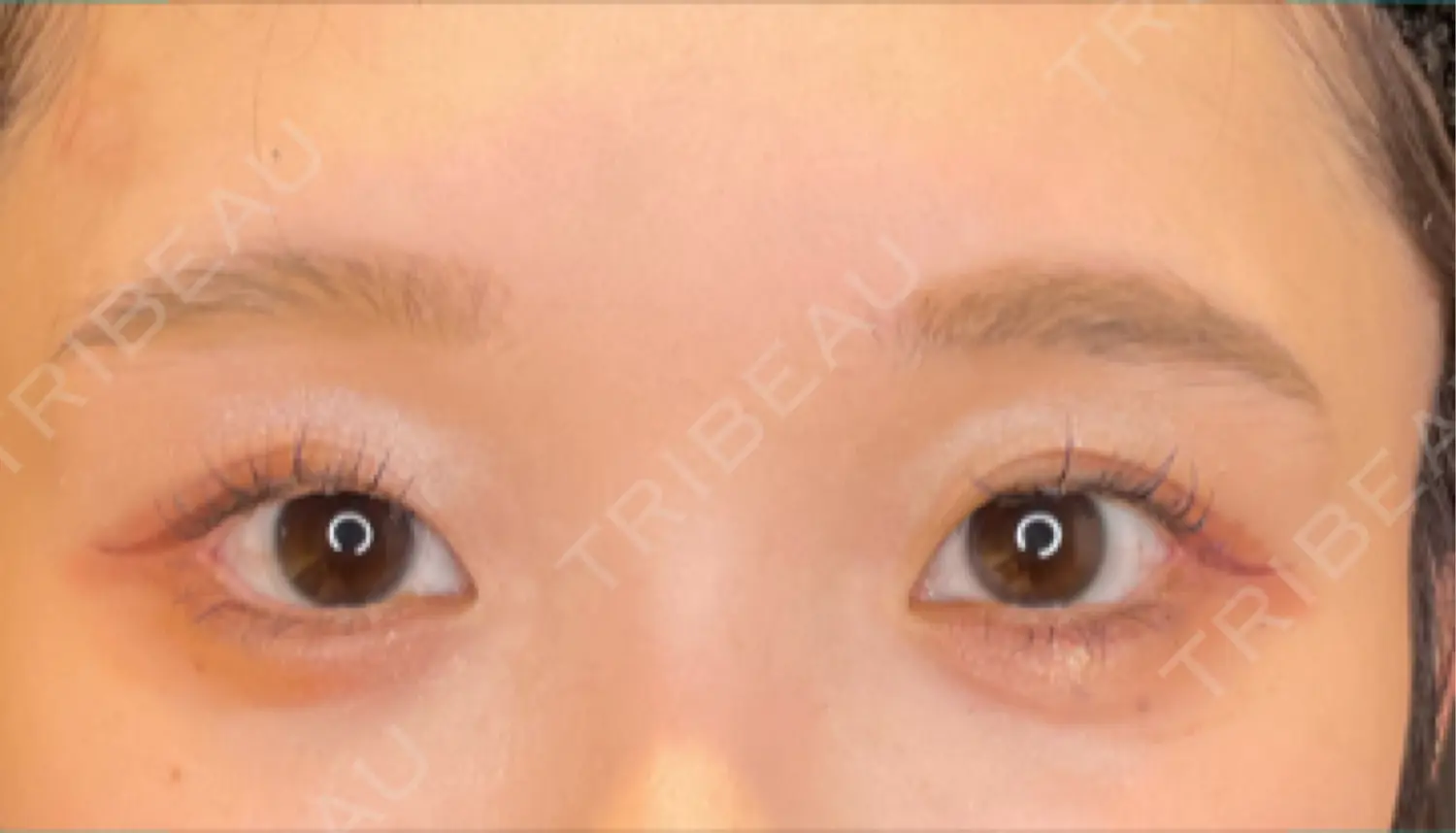 施術前の写真