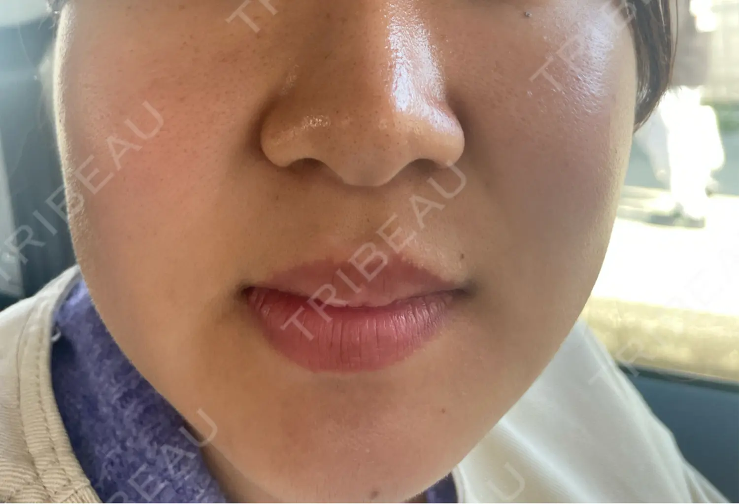 施術前の写真